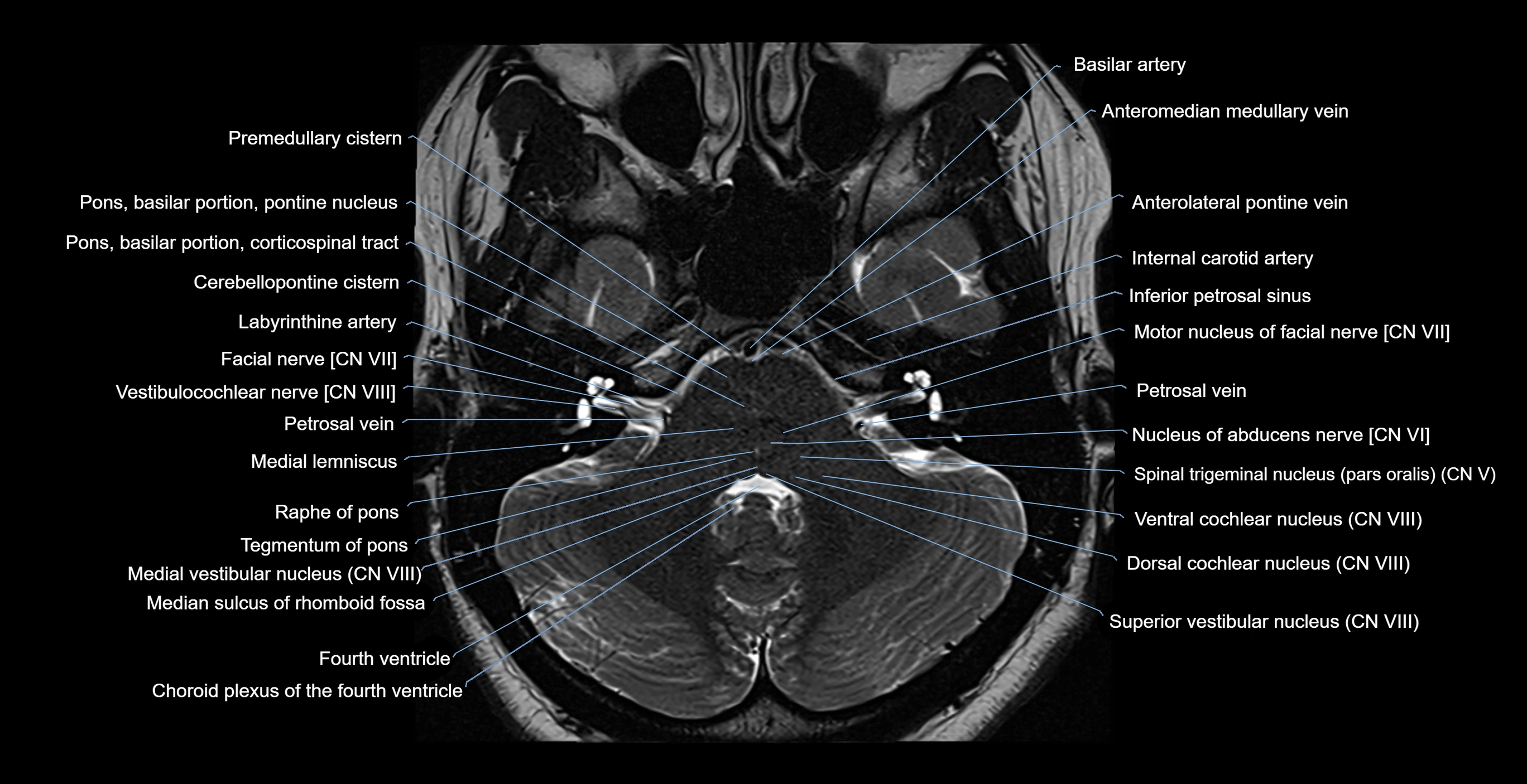 MRI-brainstem-&-basal-ganglia-anatomy-labelled-3T-MRI-images-00012.webp