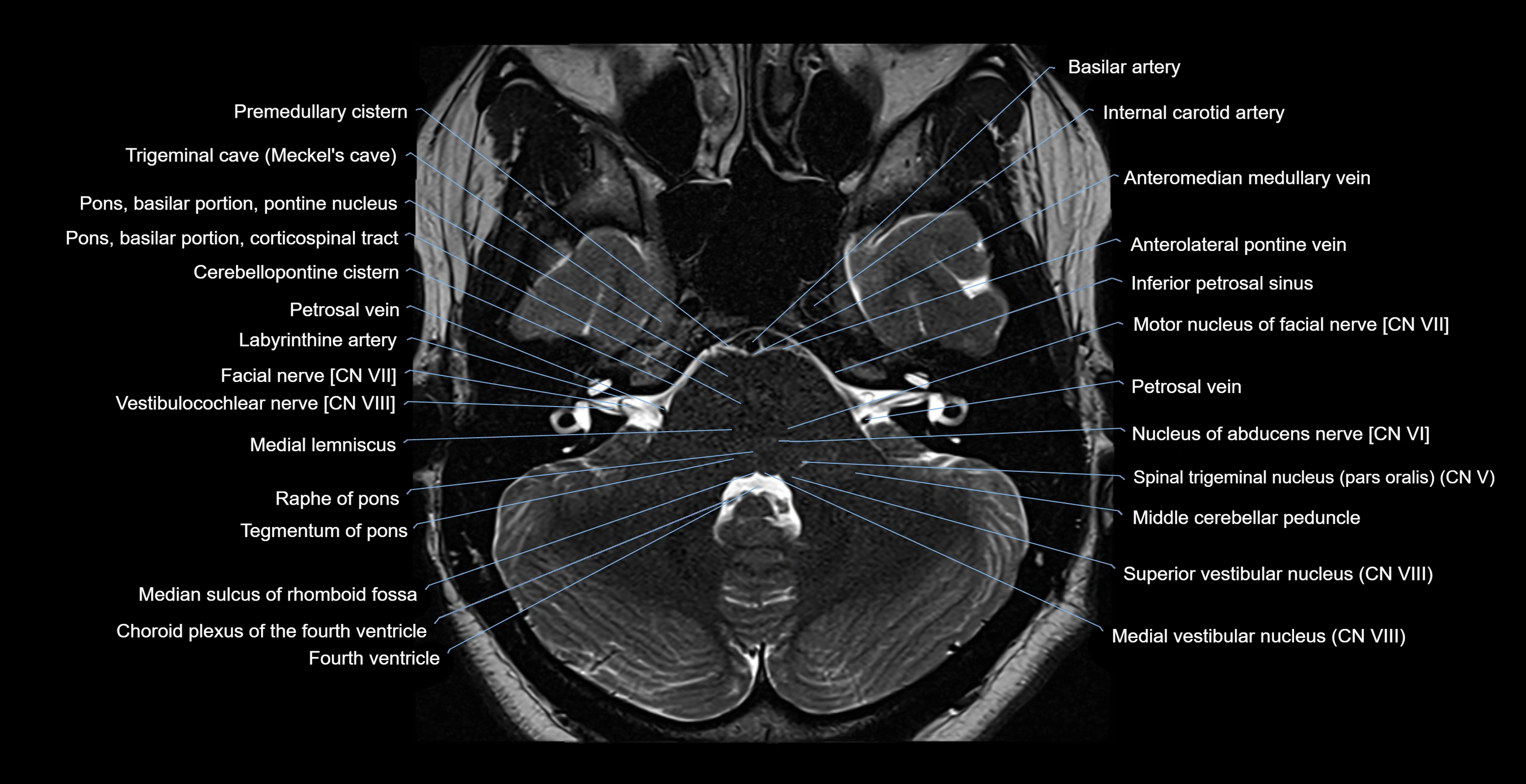 MRI-brainstem-&-basal-ganglia-anatomy-labelled-3T-MRI-images-00013.webp