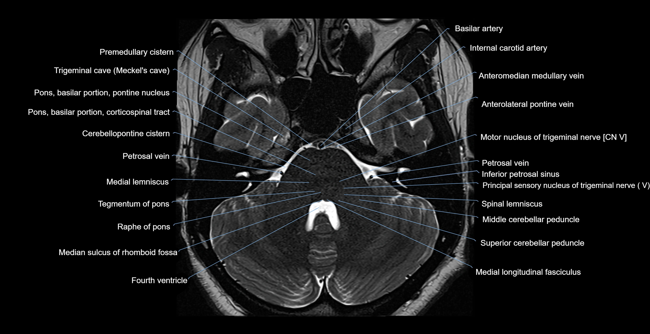 MRI-brainstem-&-basal-ganglia-anatomy-labelled-3T-MRI-images-00014.webp