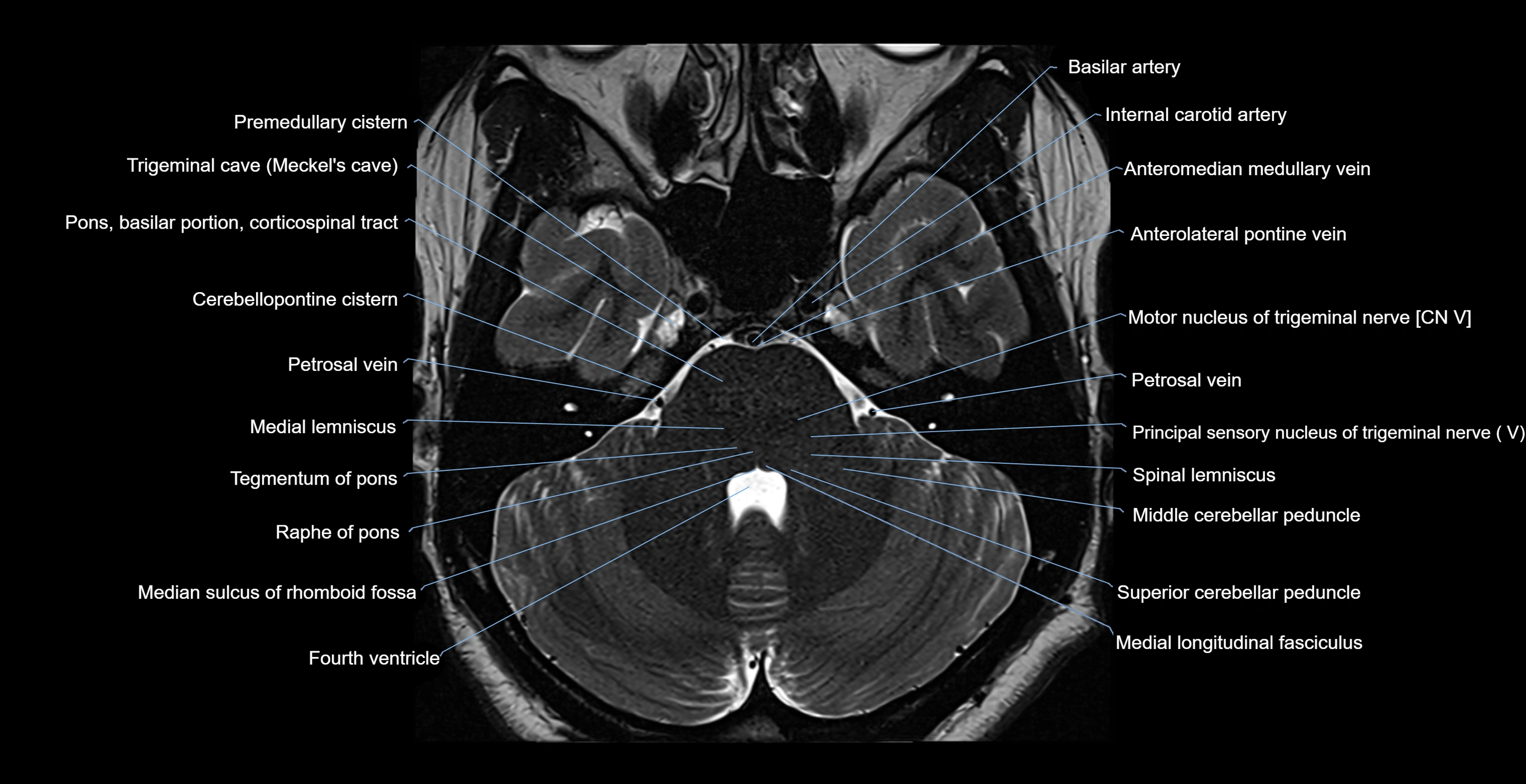 MRI-brainstem-&-basal-ganglia-anatomy-labelled-3T-MRI-images-00015.webp