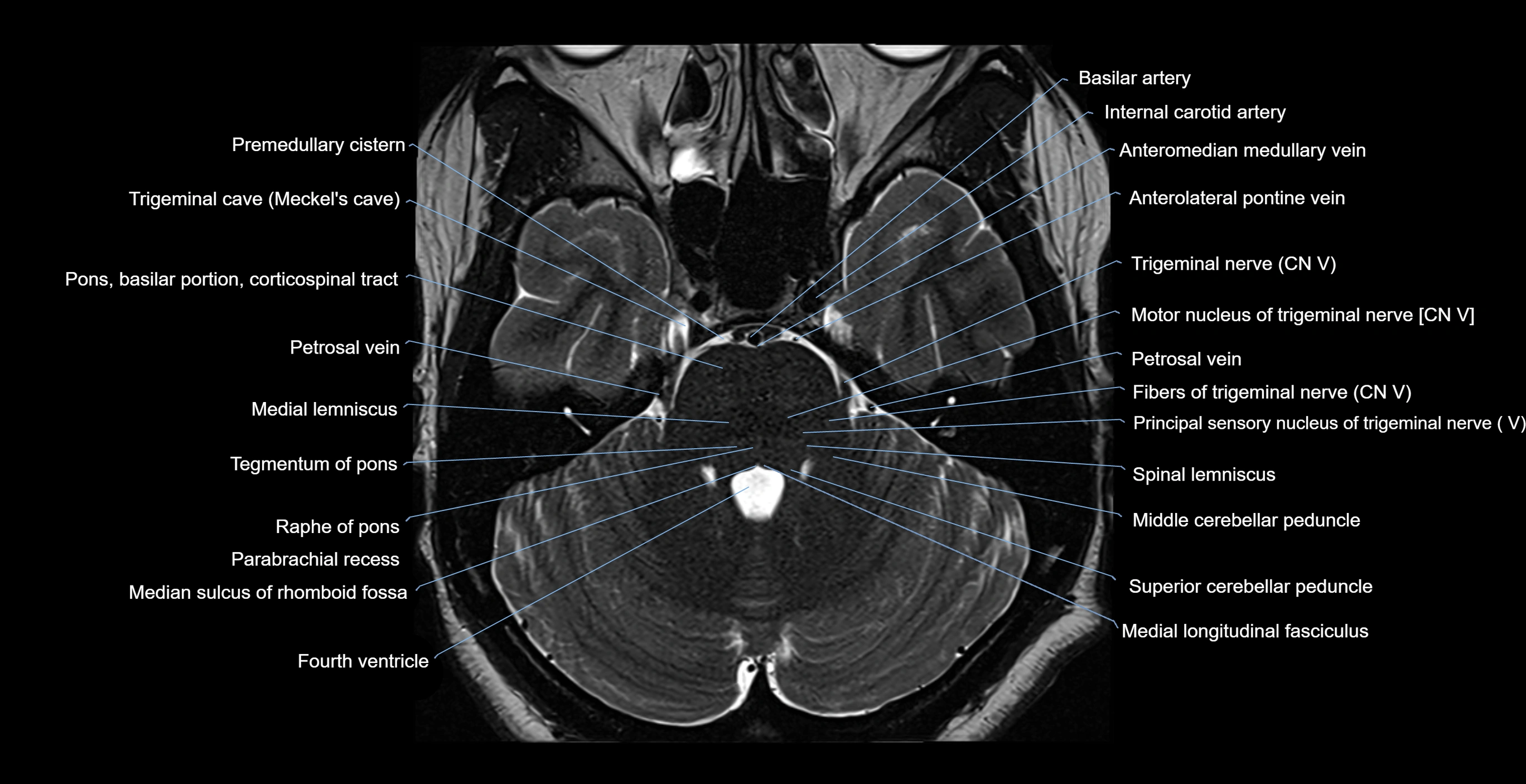 MRI-brainstem-&-basal-ganglia-anatomy-labelled-3T-MRI-images-00016.webp