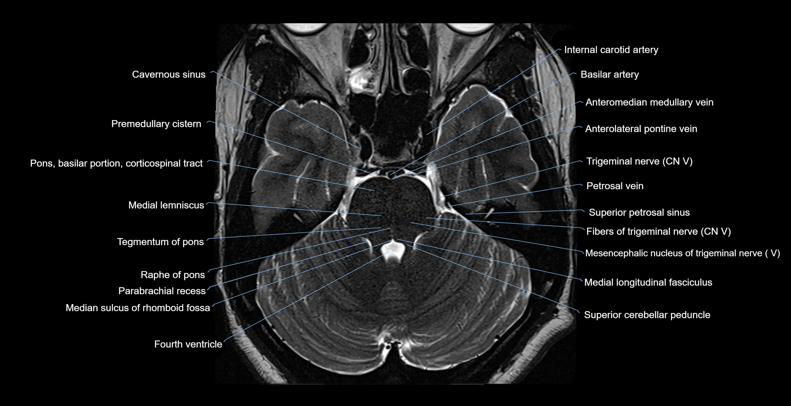 MRI-brainstem-&-basal-ganglia-anatomy-labelled-3T-MRI-images-00017.webp