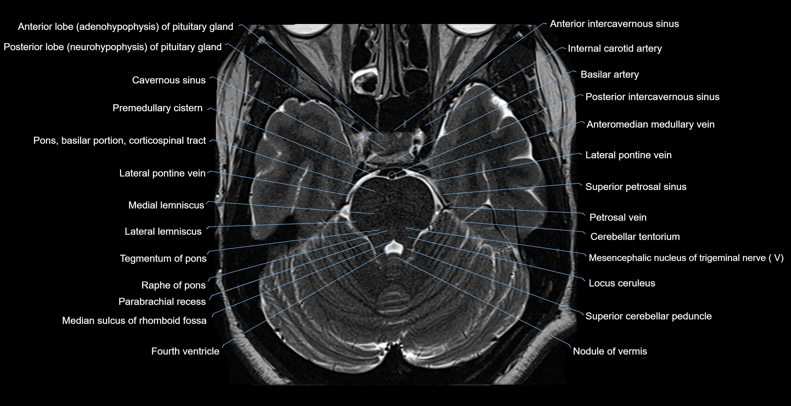 MRI-brainstem-&-basal-ganglia-anatomy-labelled-3T-MRI-images-00018.webp