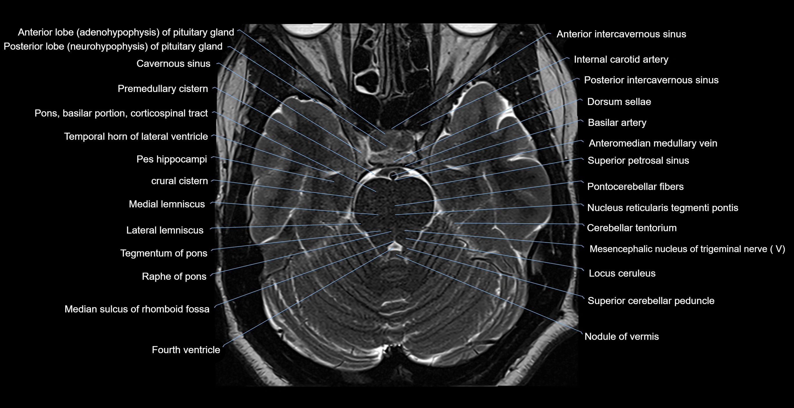 MRI-brainstem-&-basal-ganglia-anatomy-labelled-3T-MRI-images-00019.webp