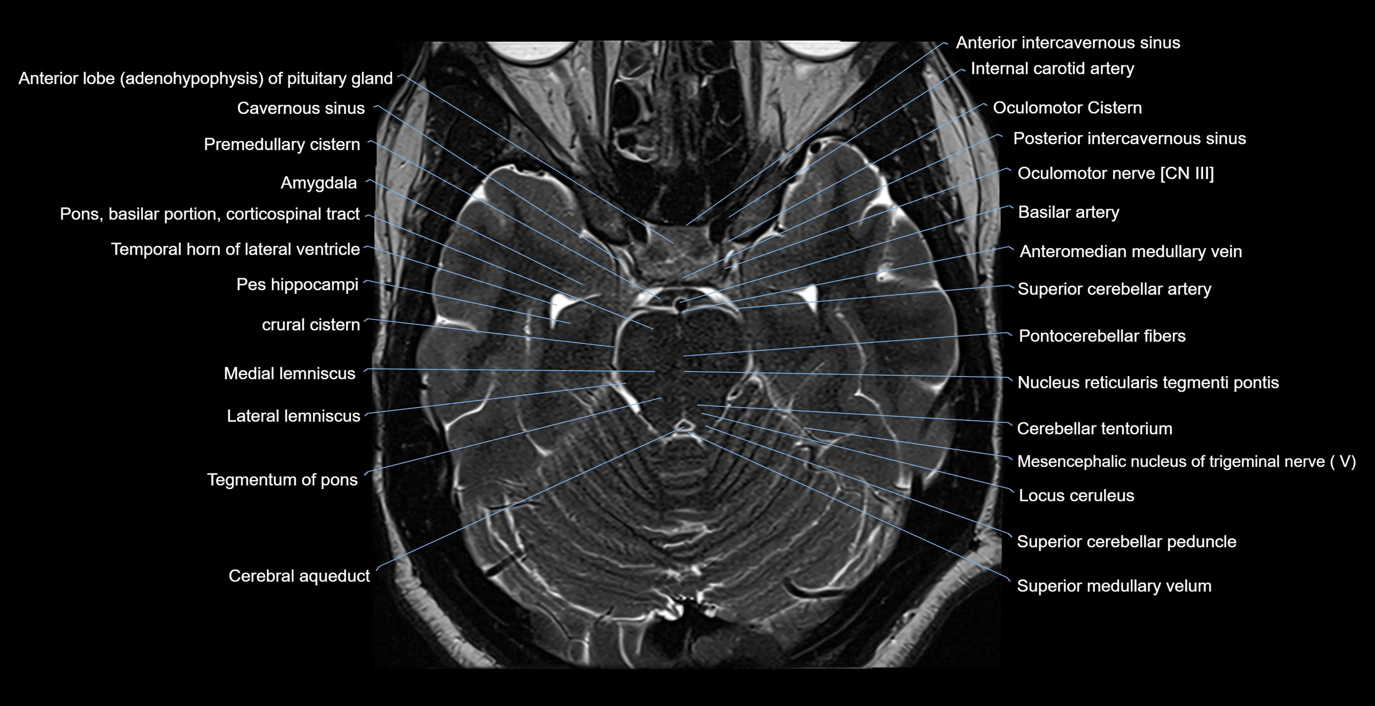 MRI-brainstem-&-basal-ganglia-anatomy-labelled-3T-MRI-images-00020.webp