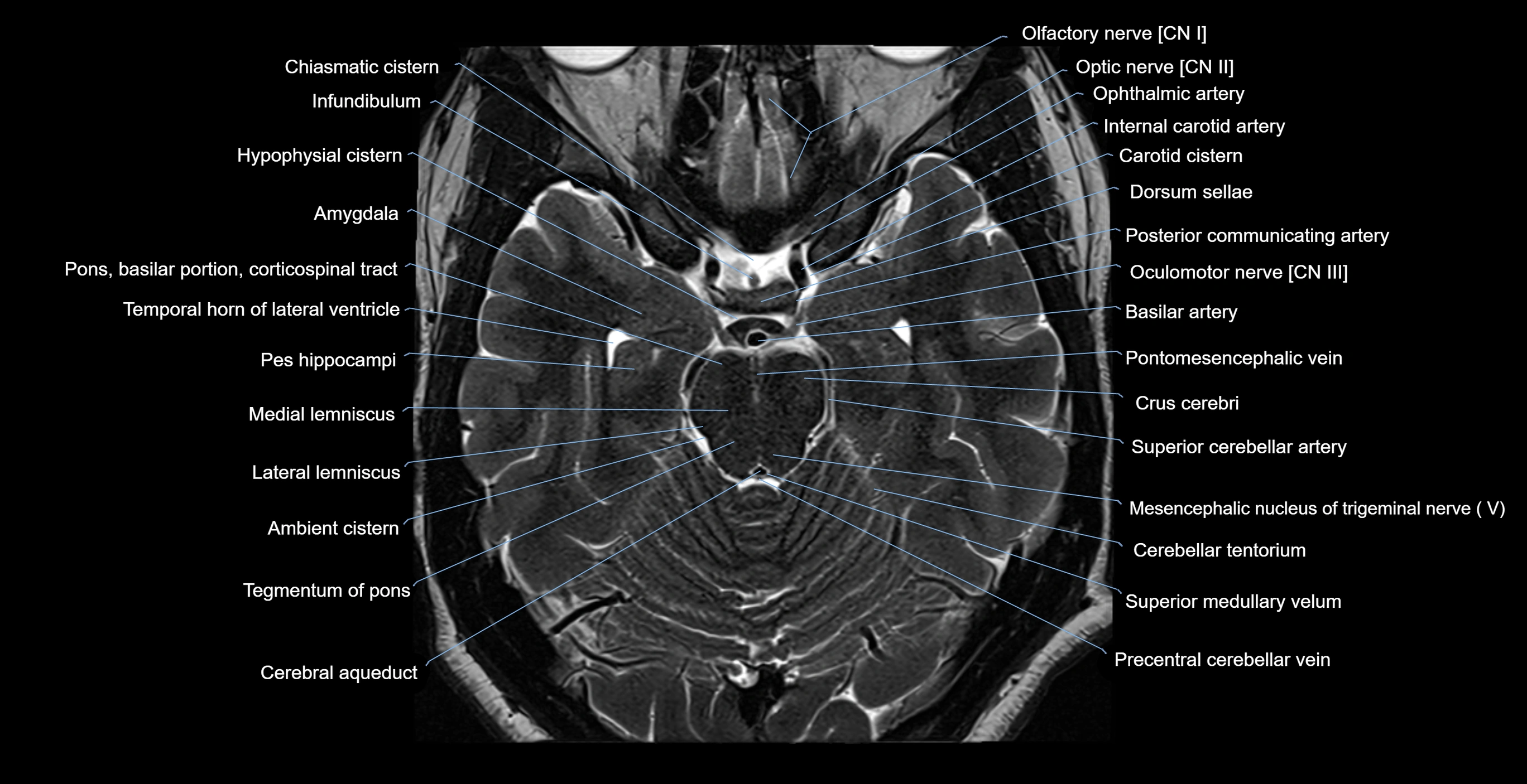 MRI-brainstem-&-basal-ganglia-anatomy-labelled-3T-MRI-images-00021.webp