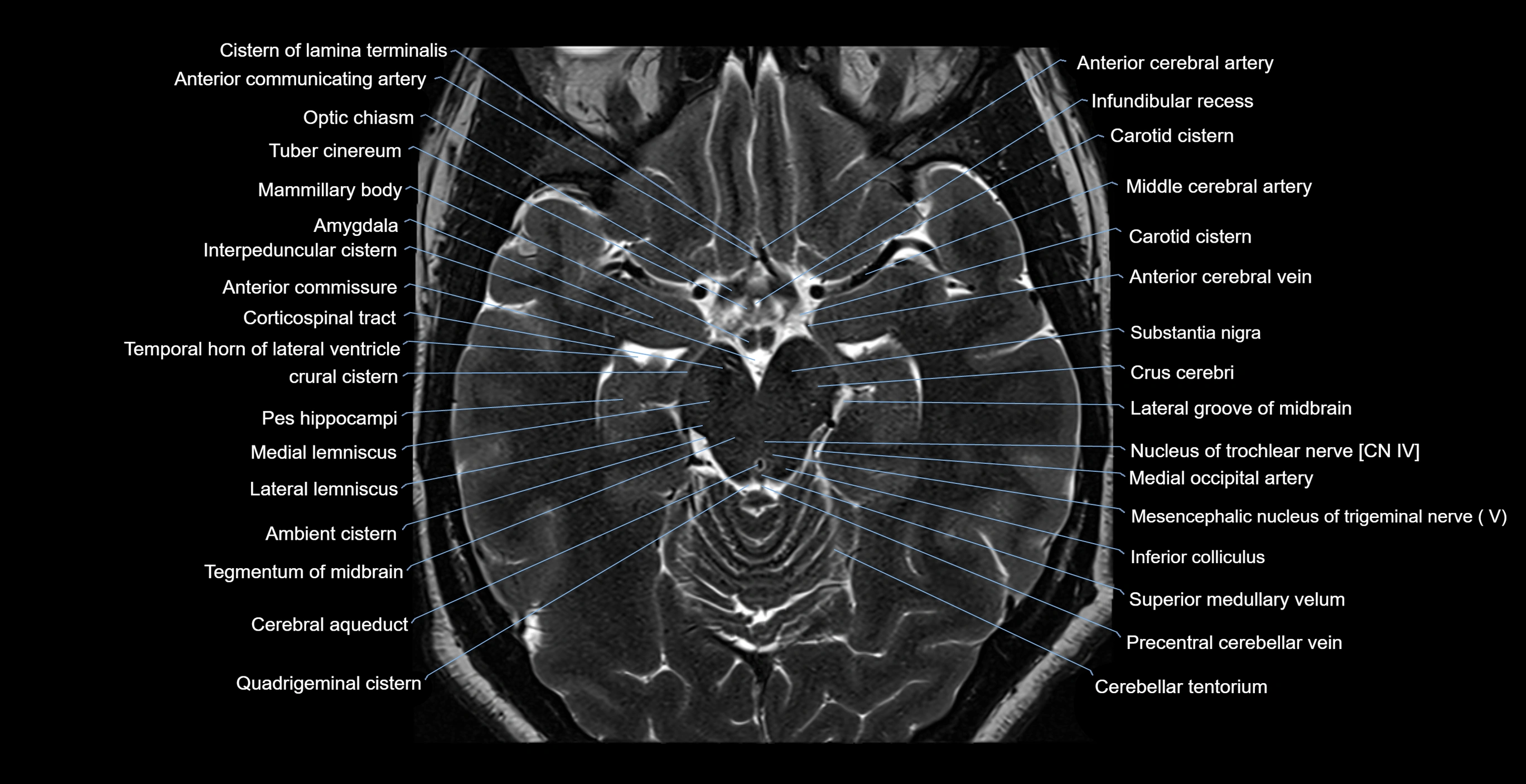 MRI-brainstem-&-basal-ganglia-anatomy-labelled-3T-MRI-images-00024.webp
