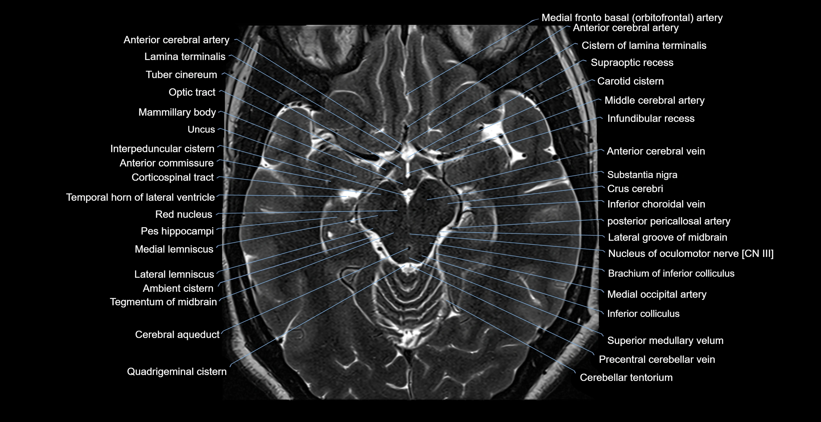 MRI-brainstem-&-basal-ganglia-anatomy-labelled-3T-MRI-images-00025.webp