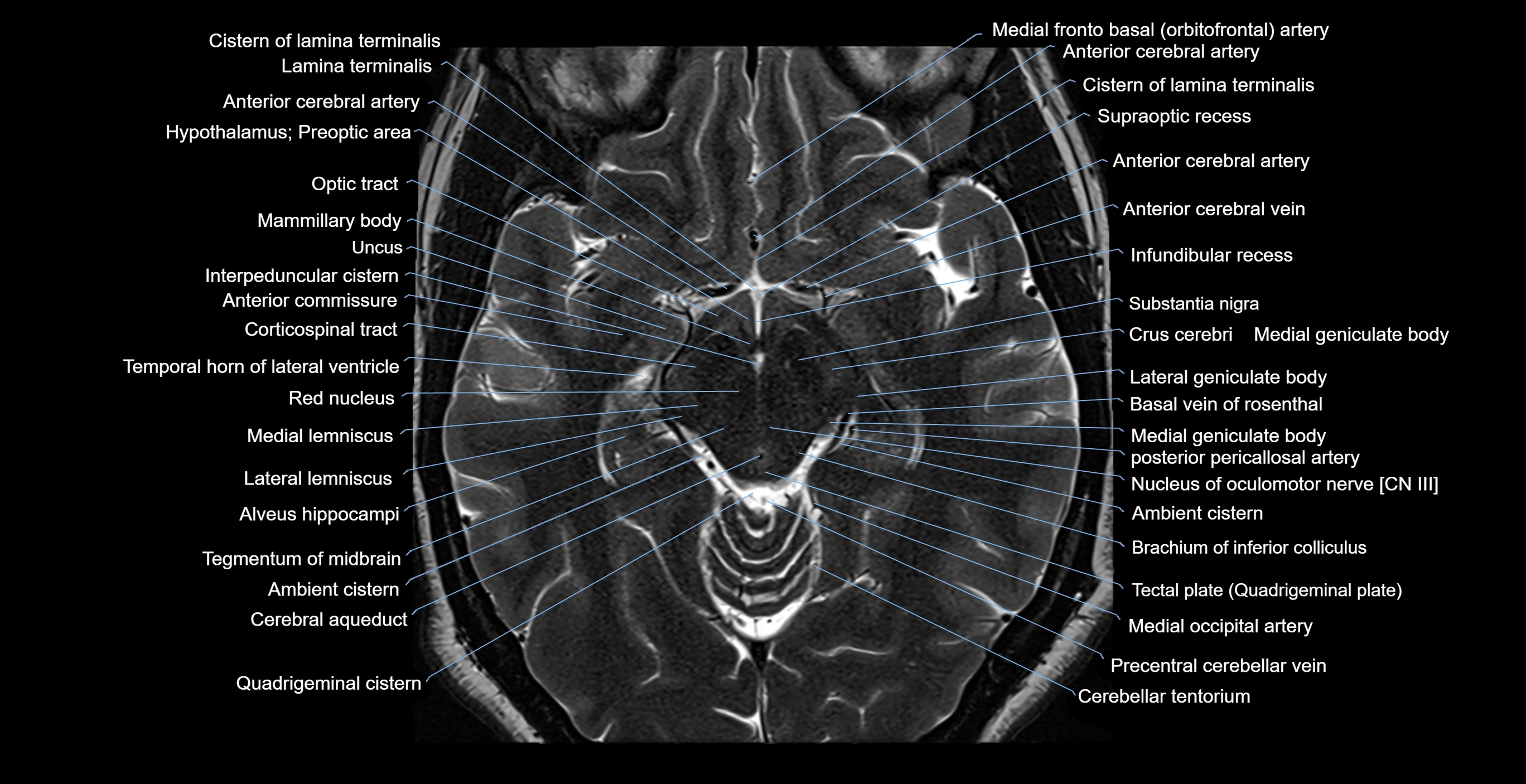 MRI-brainstem-&-basal-ganglia-anatomy-labelled-3T-MRI-images-00026.webp