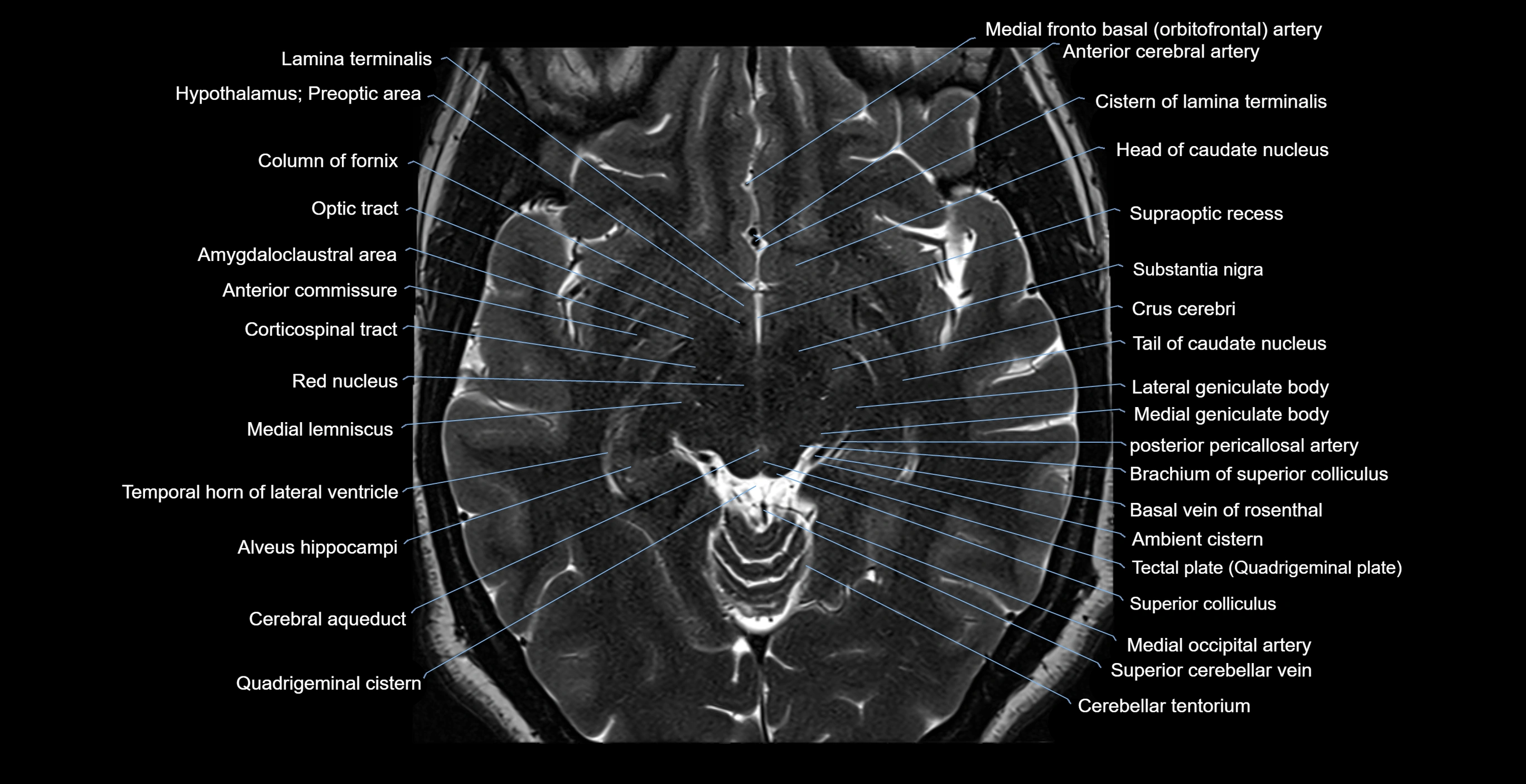 MRI-brainstem-&-basal-ganglia-anatomy-labelled-3T-MRI-images-00027.webp