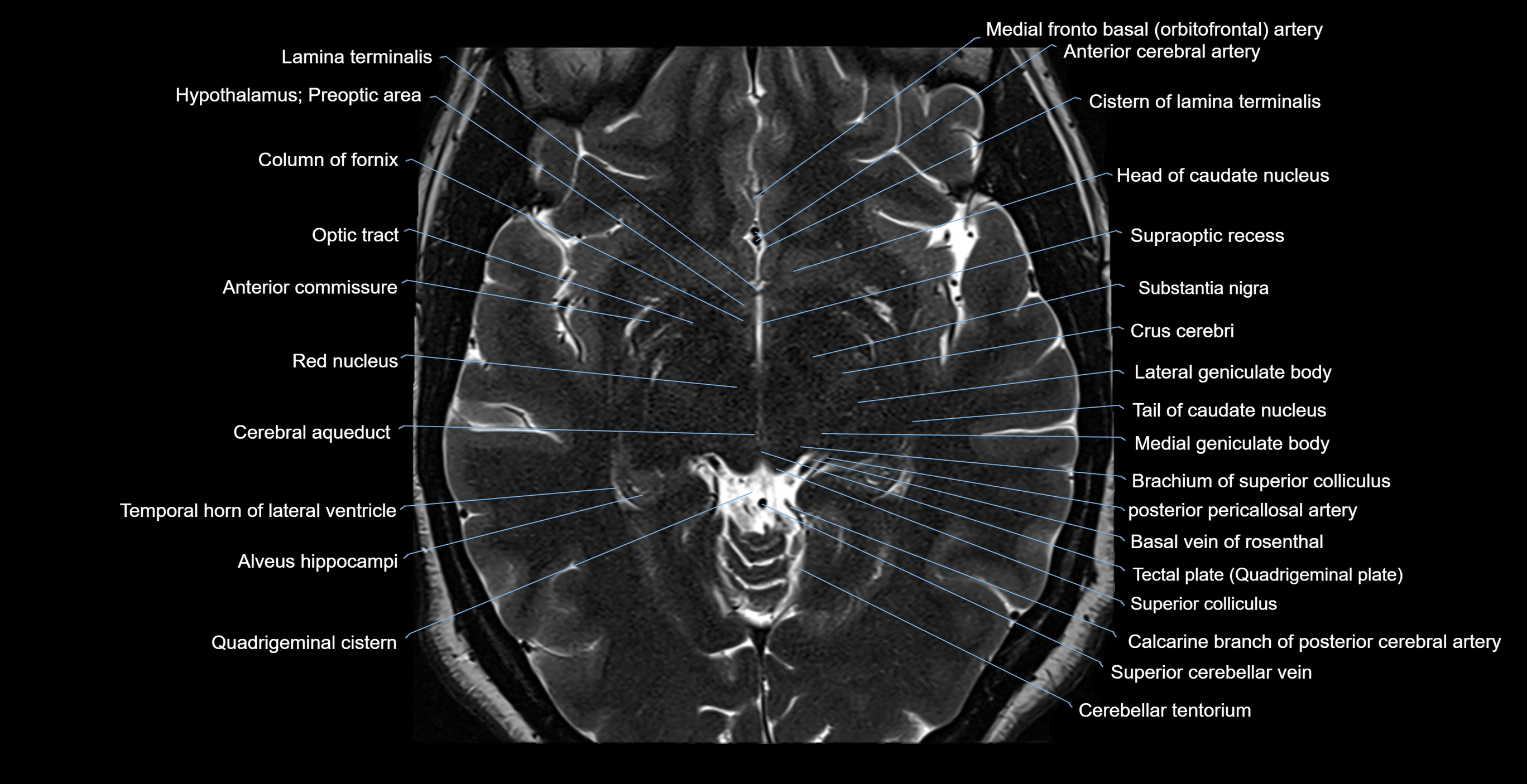 MRI-brainstem-&-basal-ganglia-anatomy-labelled-3T-MRI-images-00028.webp