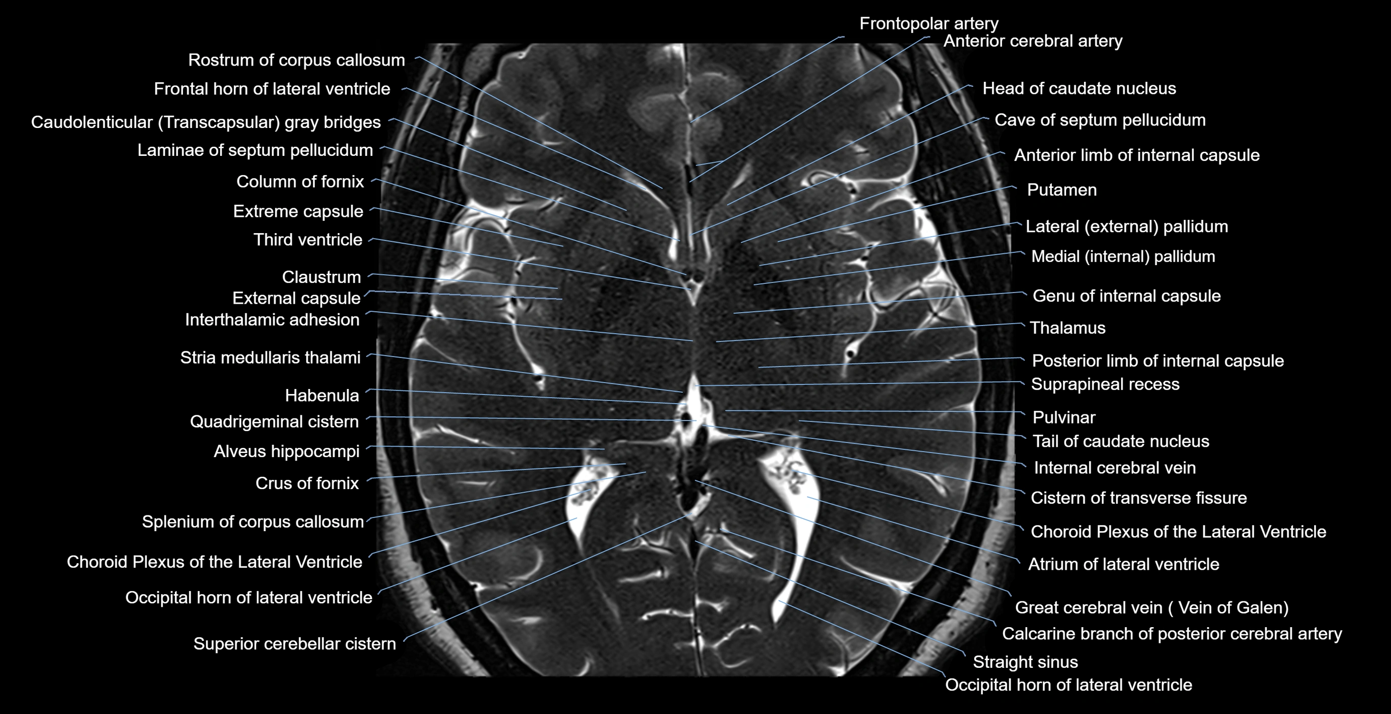 MRI-brainstem-&-basal-ganglia-anatomy-labelled-3T-MRI-images-00032.webp