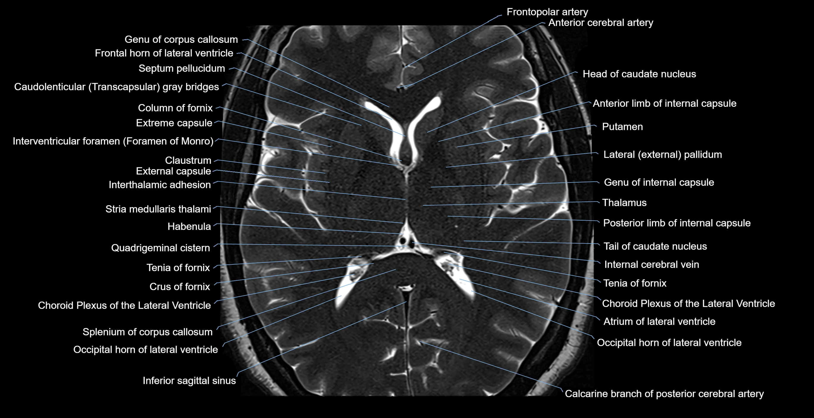 MRI-brainstem-&-basal-ganglia-anatomy-labelled-3T-MRI-images-00034.webp