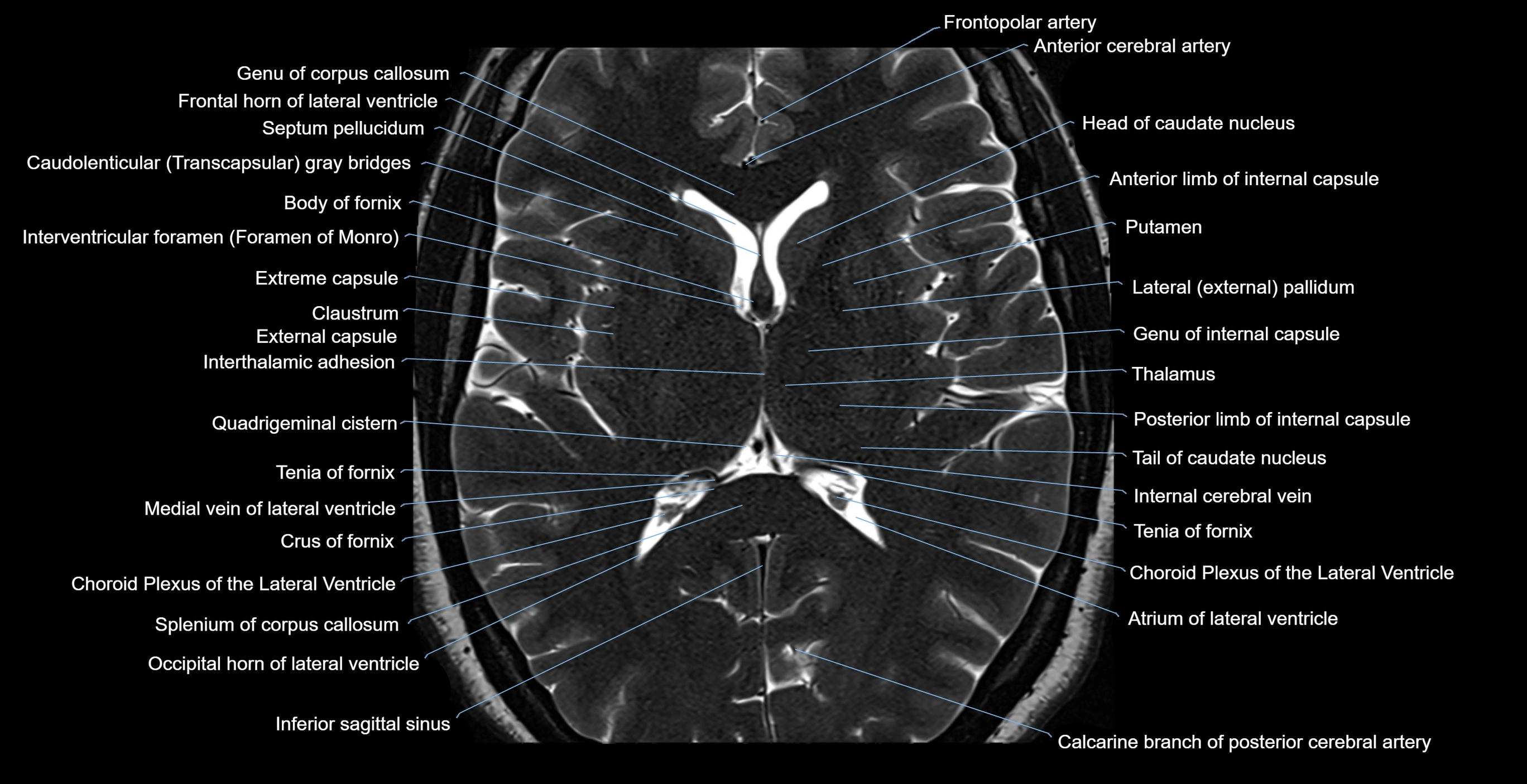 MRI-brainstem-&-basal-ganglia-anatomy-labelled-3T-MRI-images-00035.webp