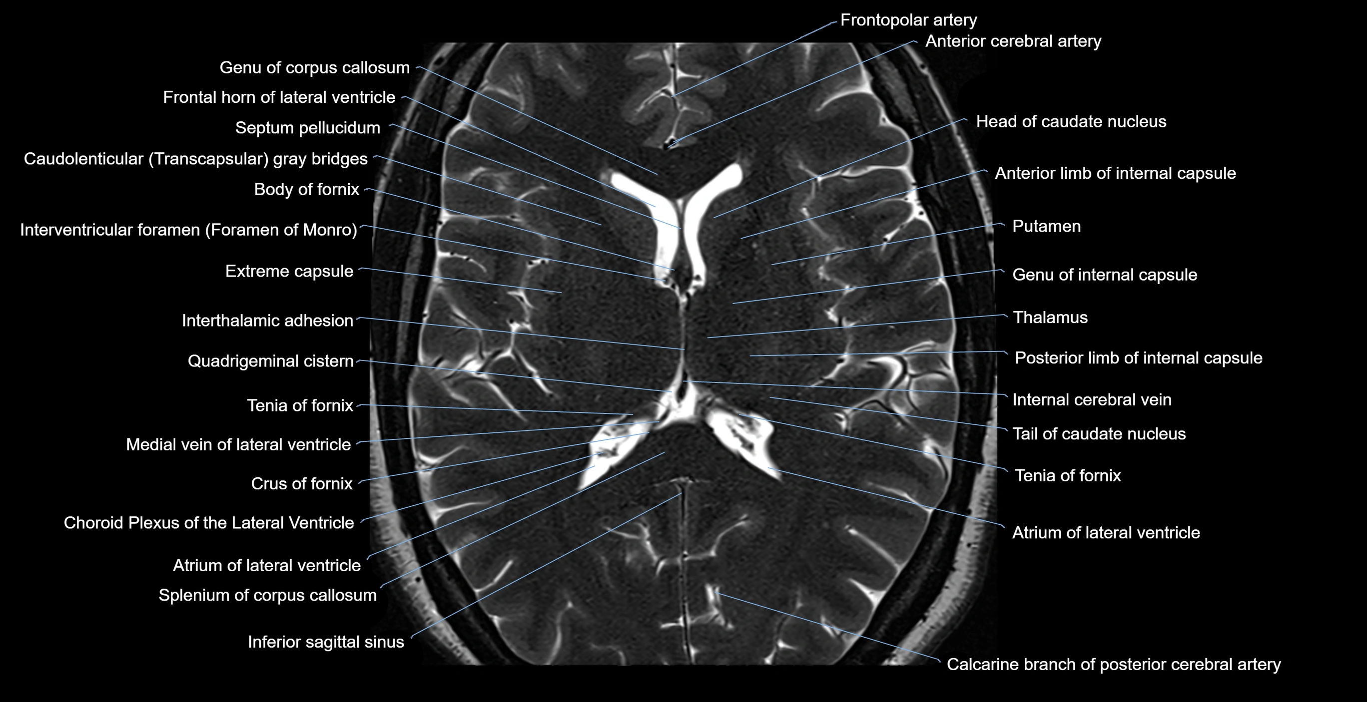MRI-brainstem-&-basal-ganglia-anatomy-labelled-3T-MRI-images-00036.webp