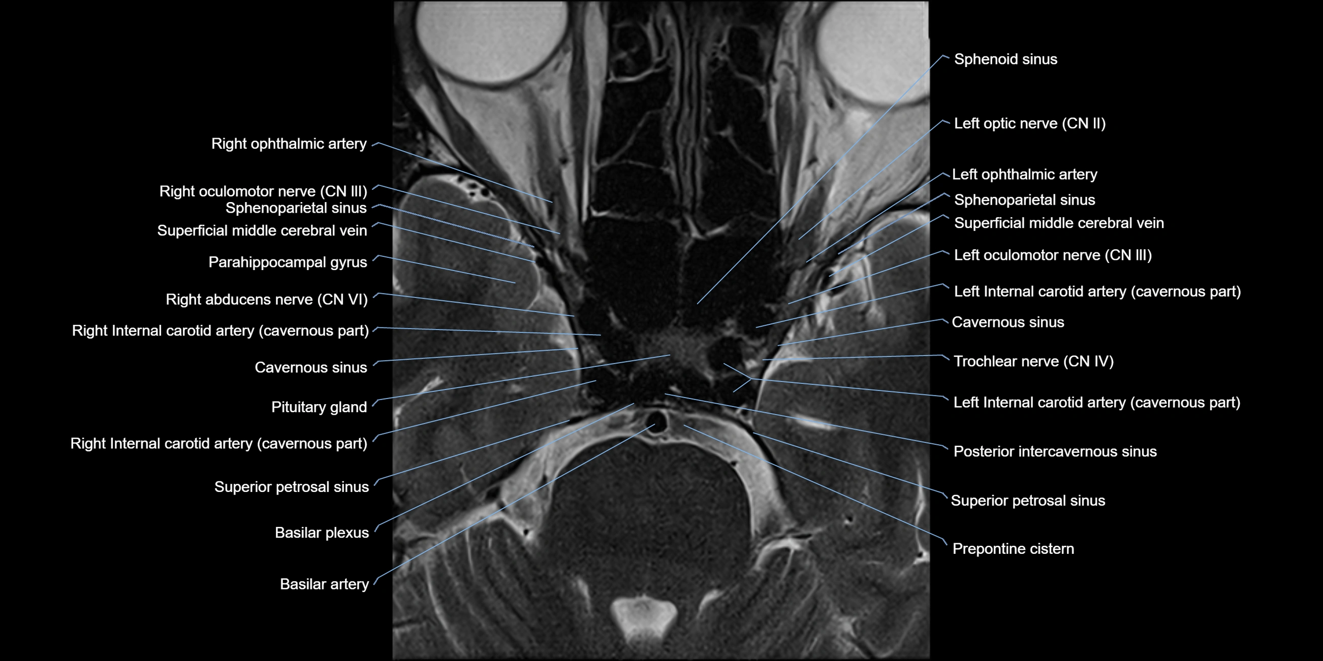 MRI-cavernous-sinus-axial-cross-sectional-3T-anatomy-labelled-radiology--image-00010.webp