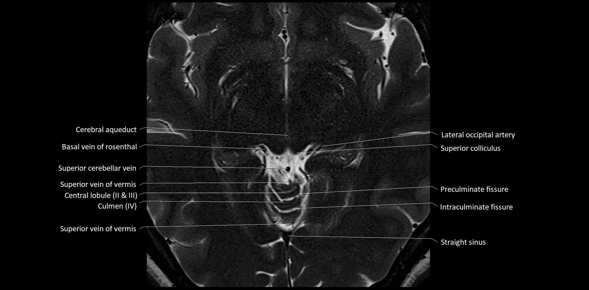MRI-Cerebellar-anatomy-High-resolution-labelled-3T-MRI-image-28.webp