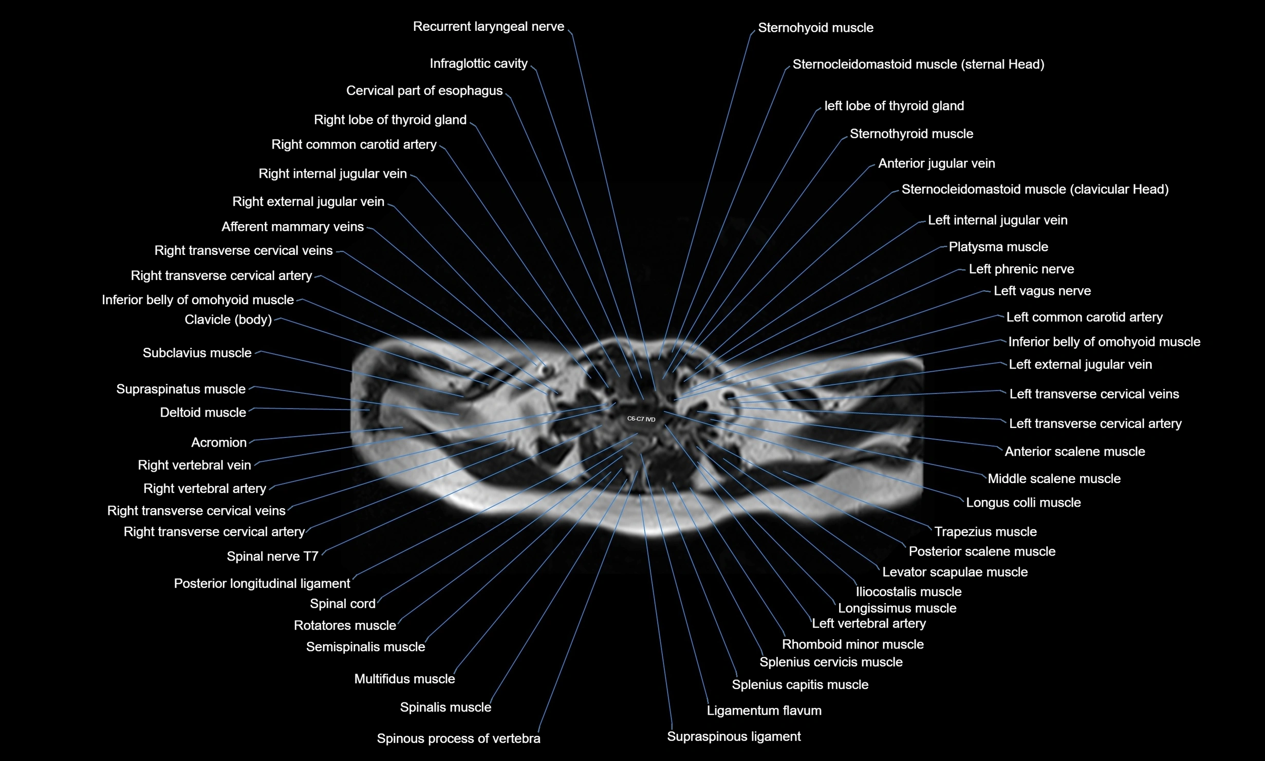 MRI Chest Anatomy – Axial, Coronal & Sagittal Planes with Labeled Images