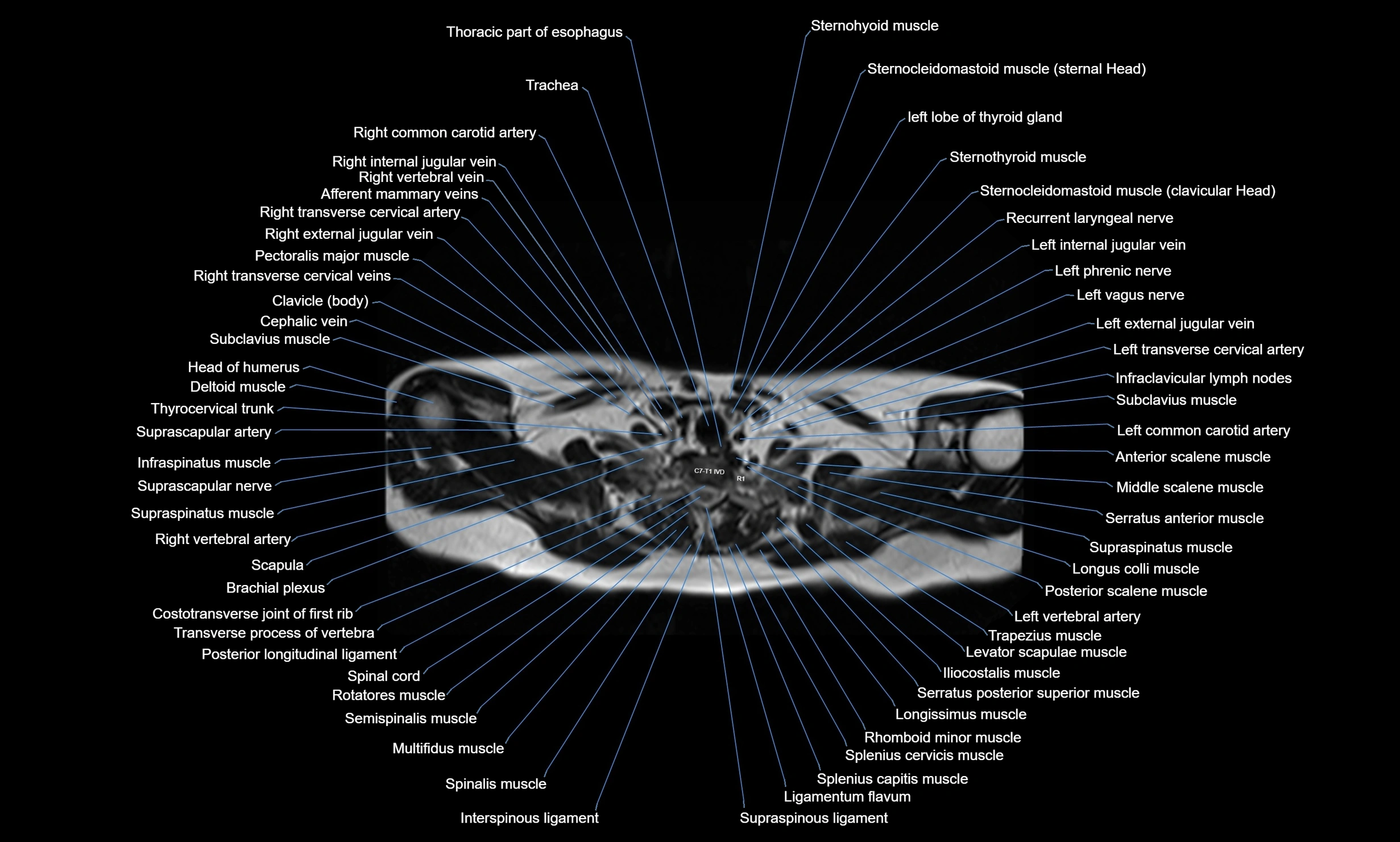 MRI Chest Anatomy – Axial, Coronal & Sagittal Planes with Labeled Images