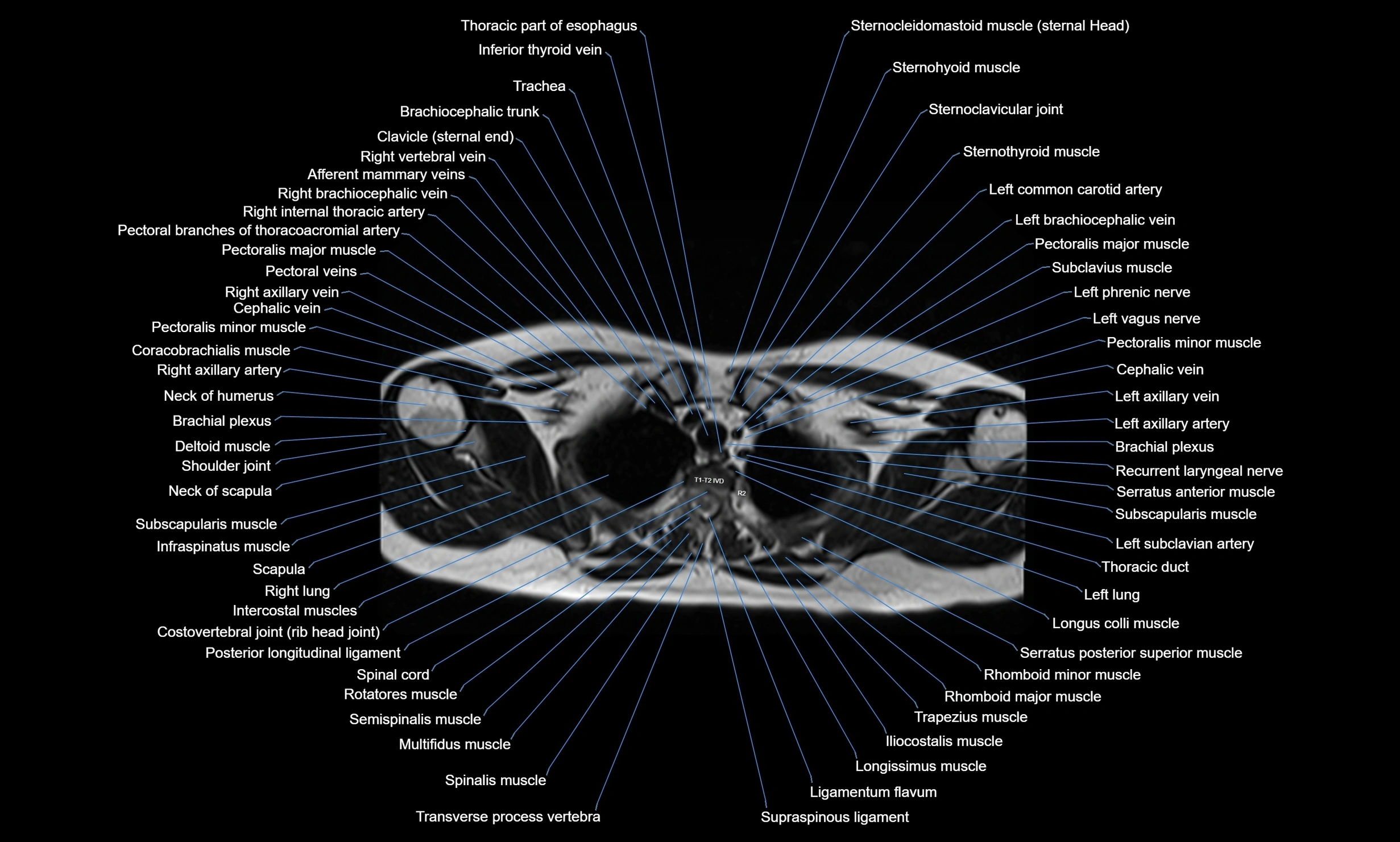 MRI Chest Anatomy – Axial, Coronal & Sagittal Planes with Labeled Images