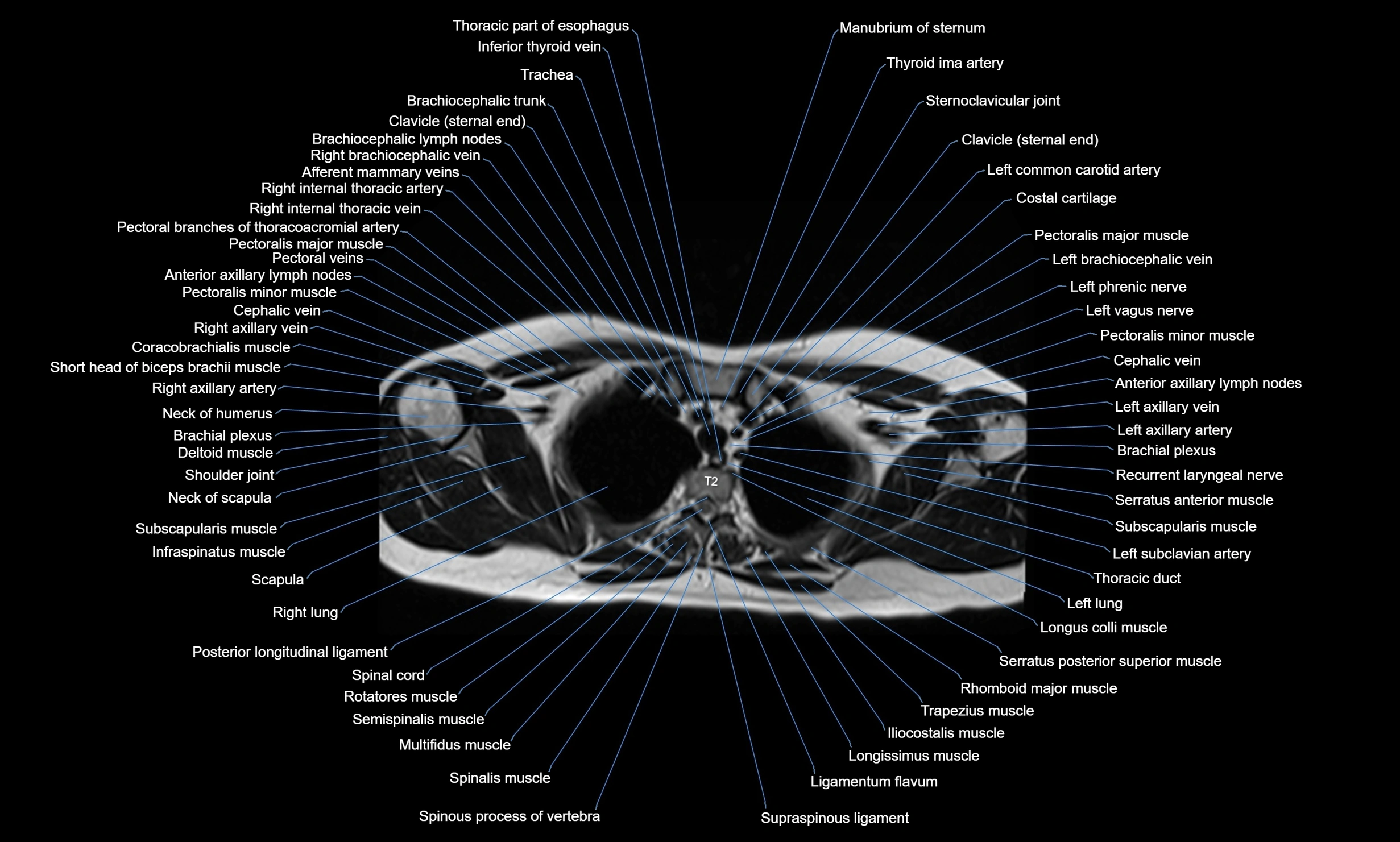 MRI Chest Anatomy – Axial, Coronal & Sagittal Planes with Labeled Images
