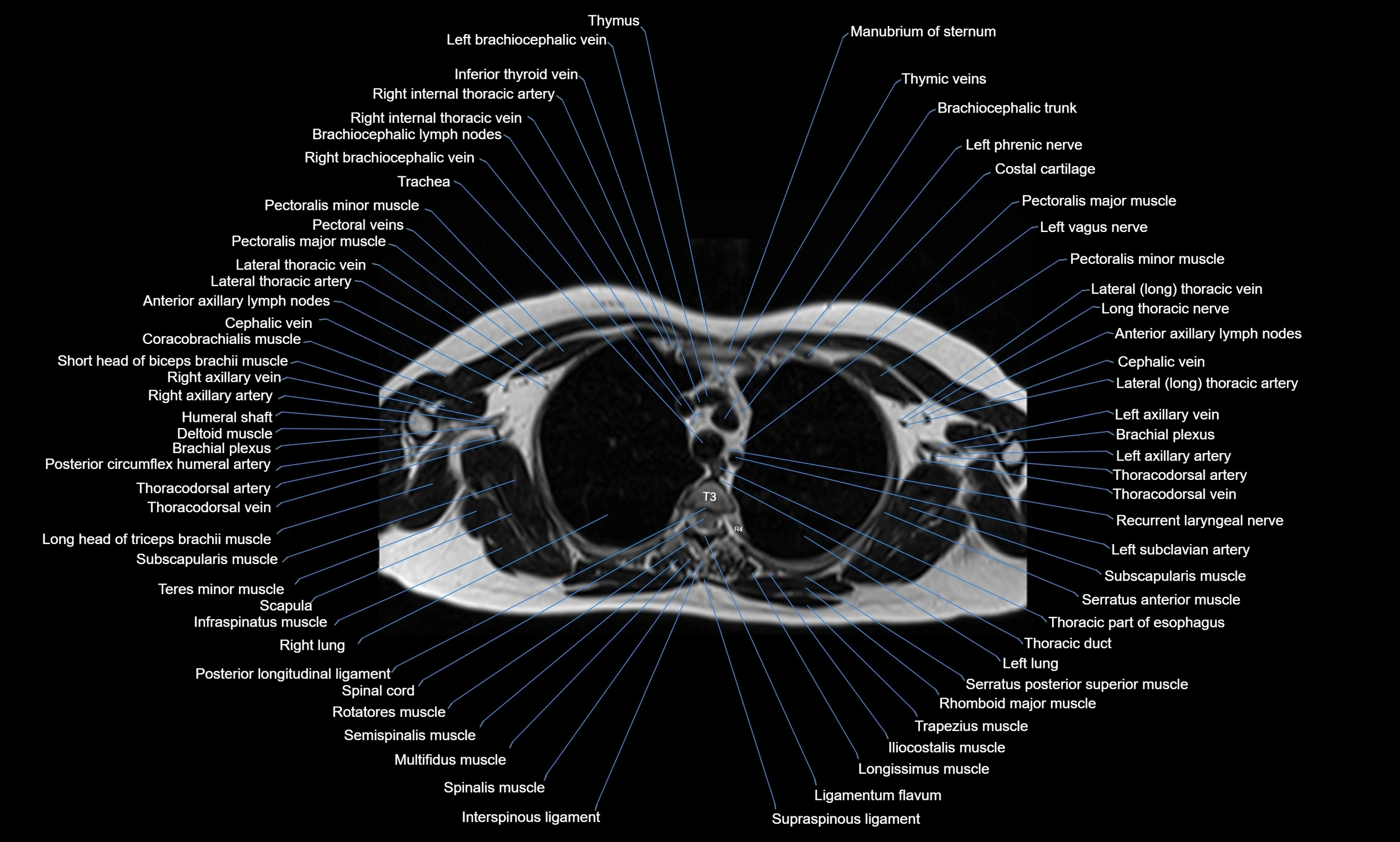 MRI Chest Anatomy – Axial, Coronal & Sagittal Planes with Labeled Images