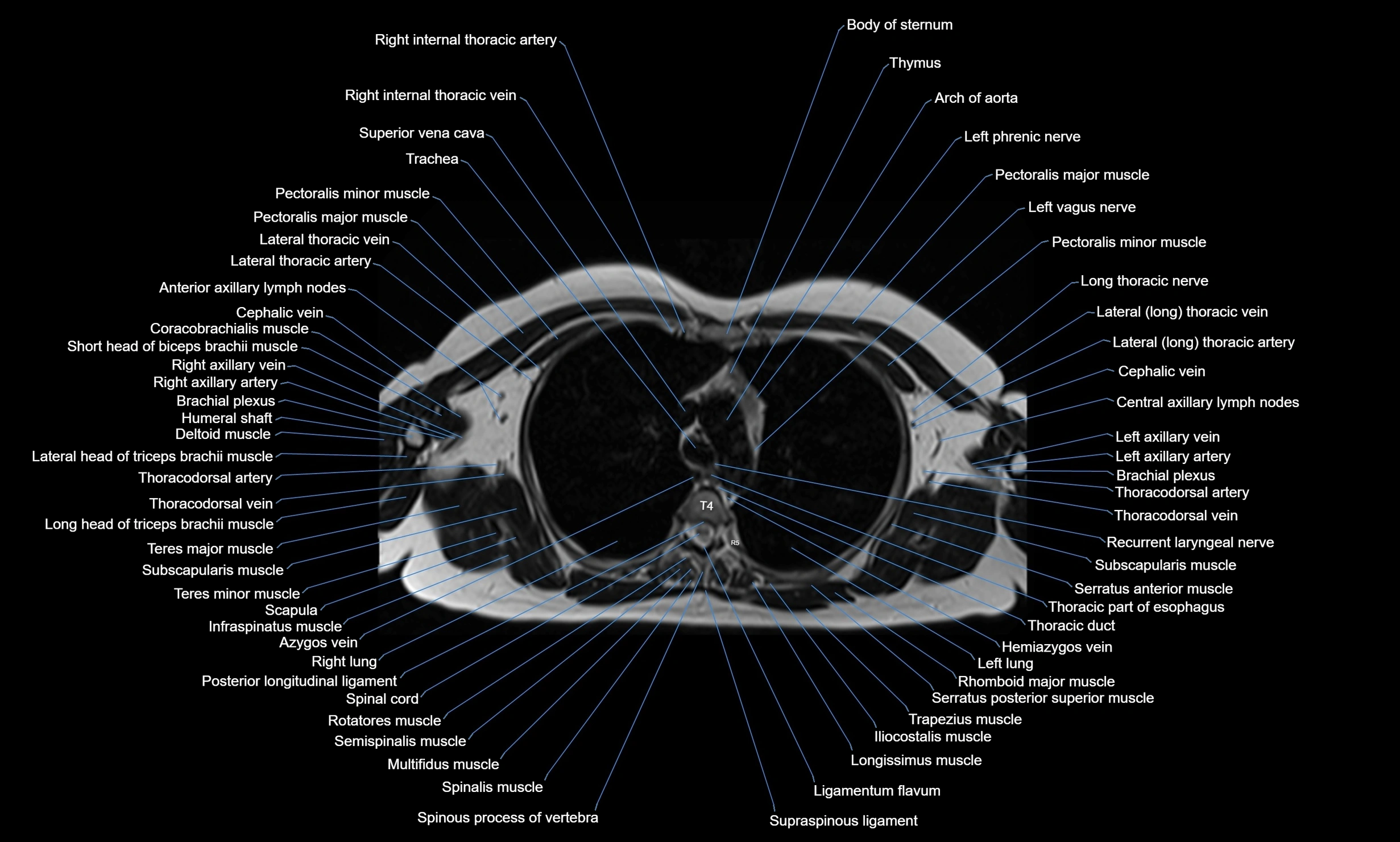 MRI Chest Anatomy – Axial, Coronal & Sagittal Planes with Labeled Images