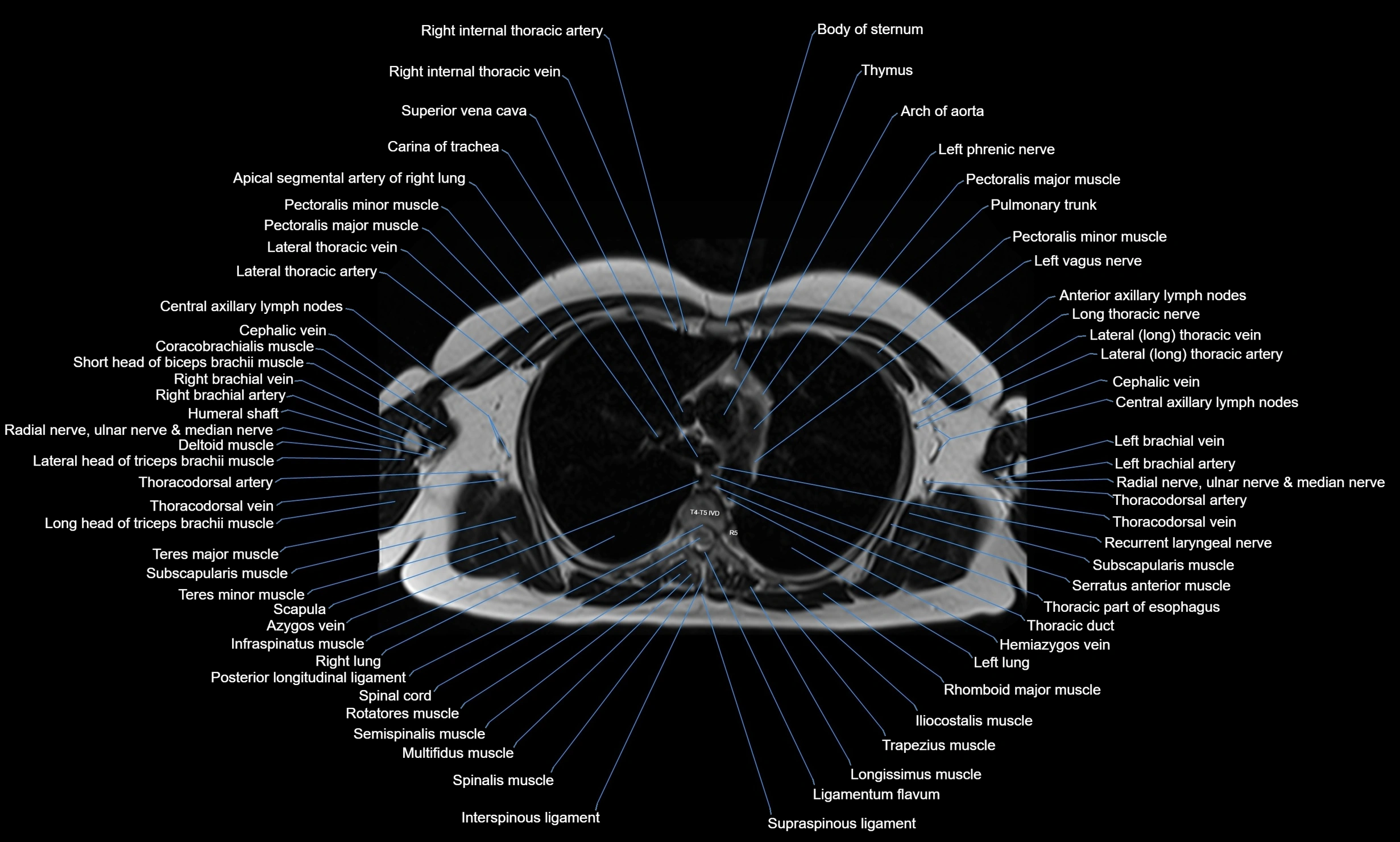 MRI Chest Anatomy – Axial, Coronal & Sagittal Planes with Labeled Images