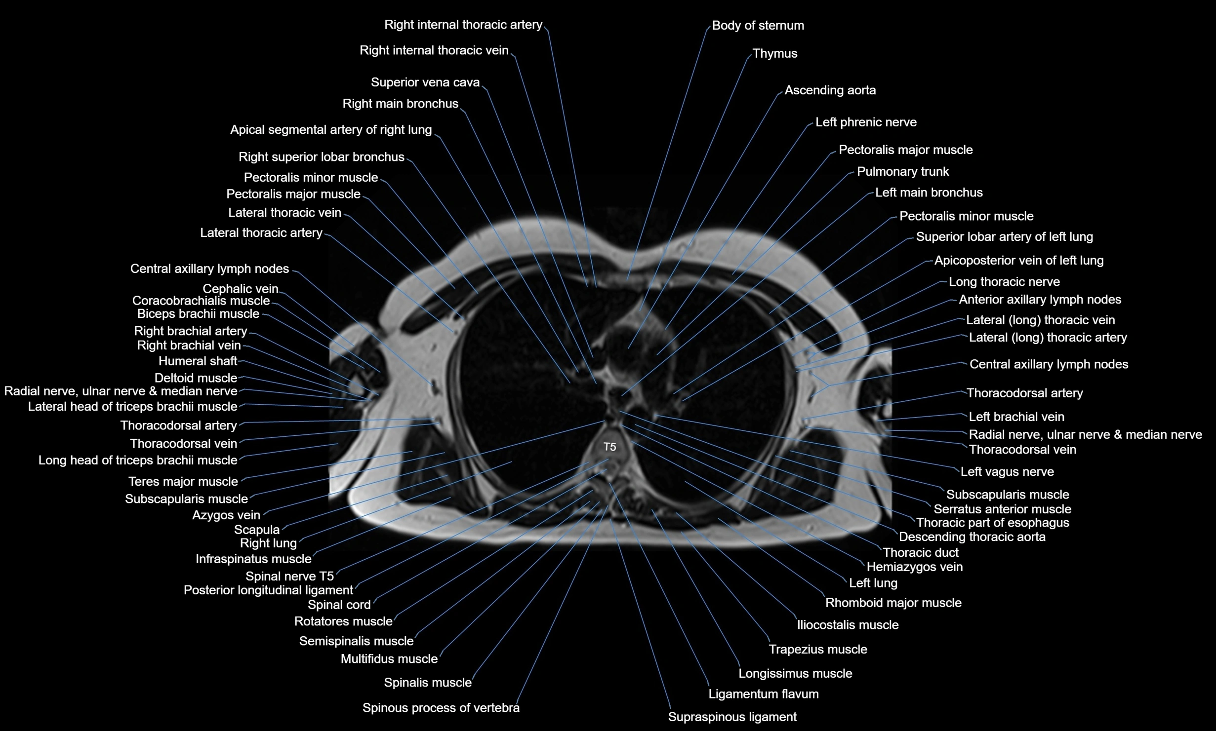 MRI Chest Anatomy – Axial, Coronal & Sagittal Planes with Labeled Images