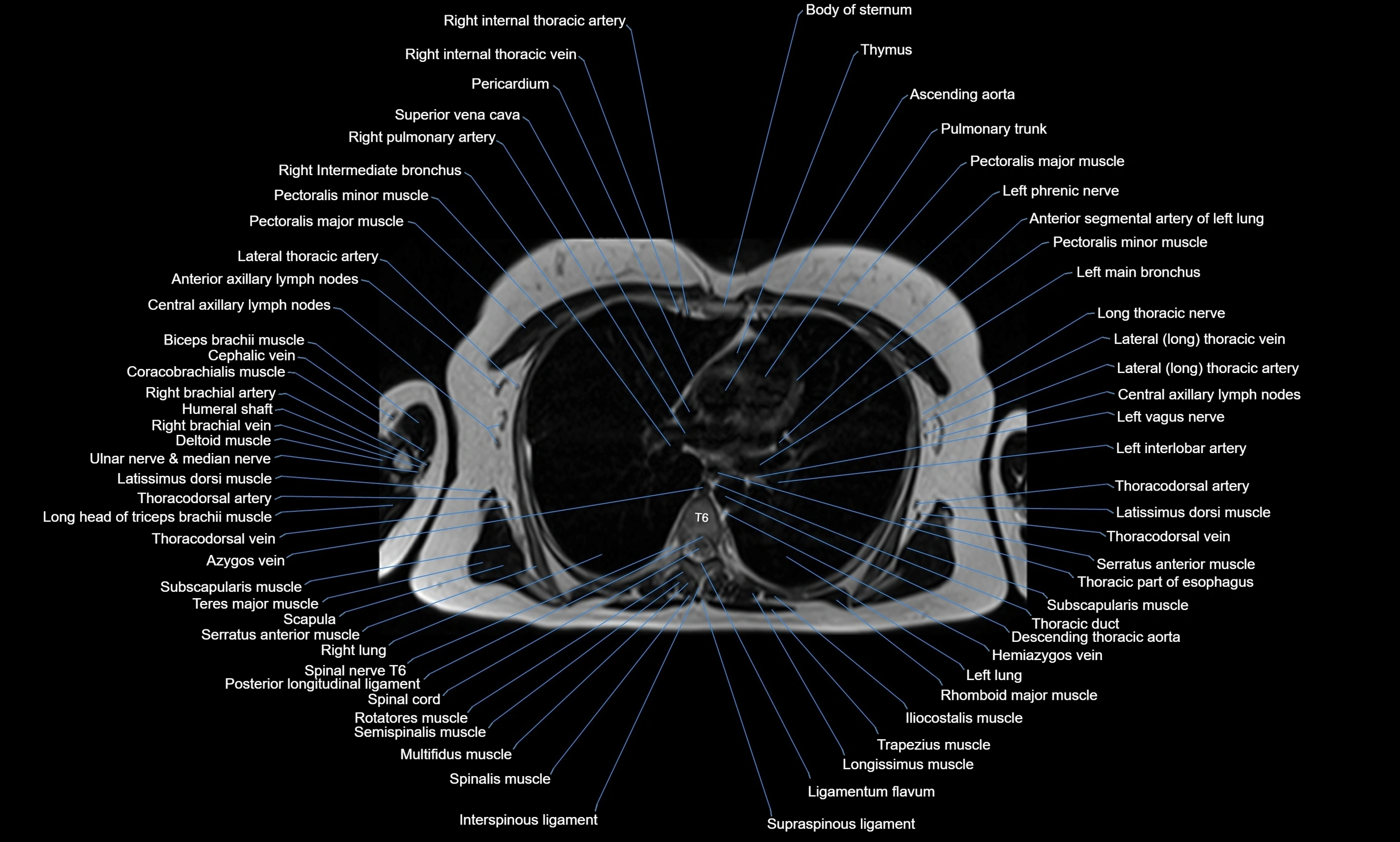 MRI Chest Anatomy – Axial, Coronal & Sagittal Planes with Labeled Images