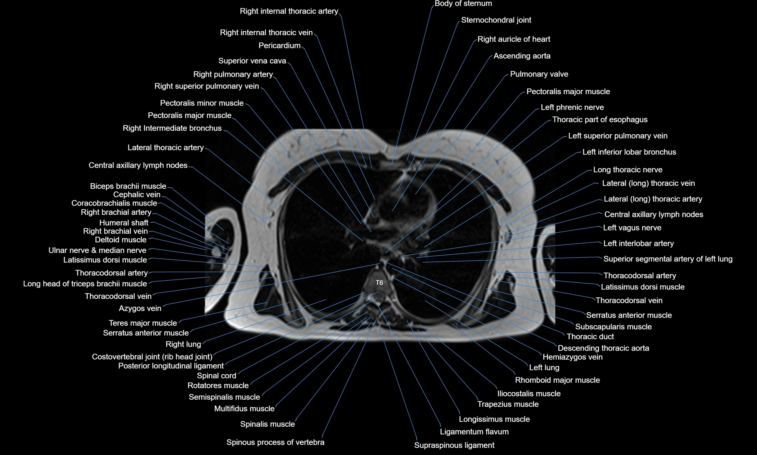 MRI Chest Anatomy – Axial, Coronal & Sagittal Planes with Labeled Images