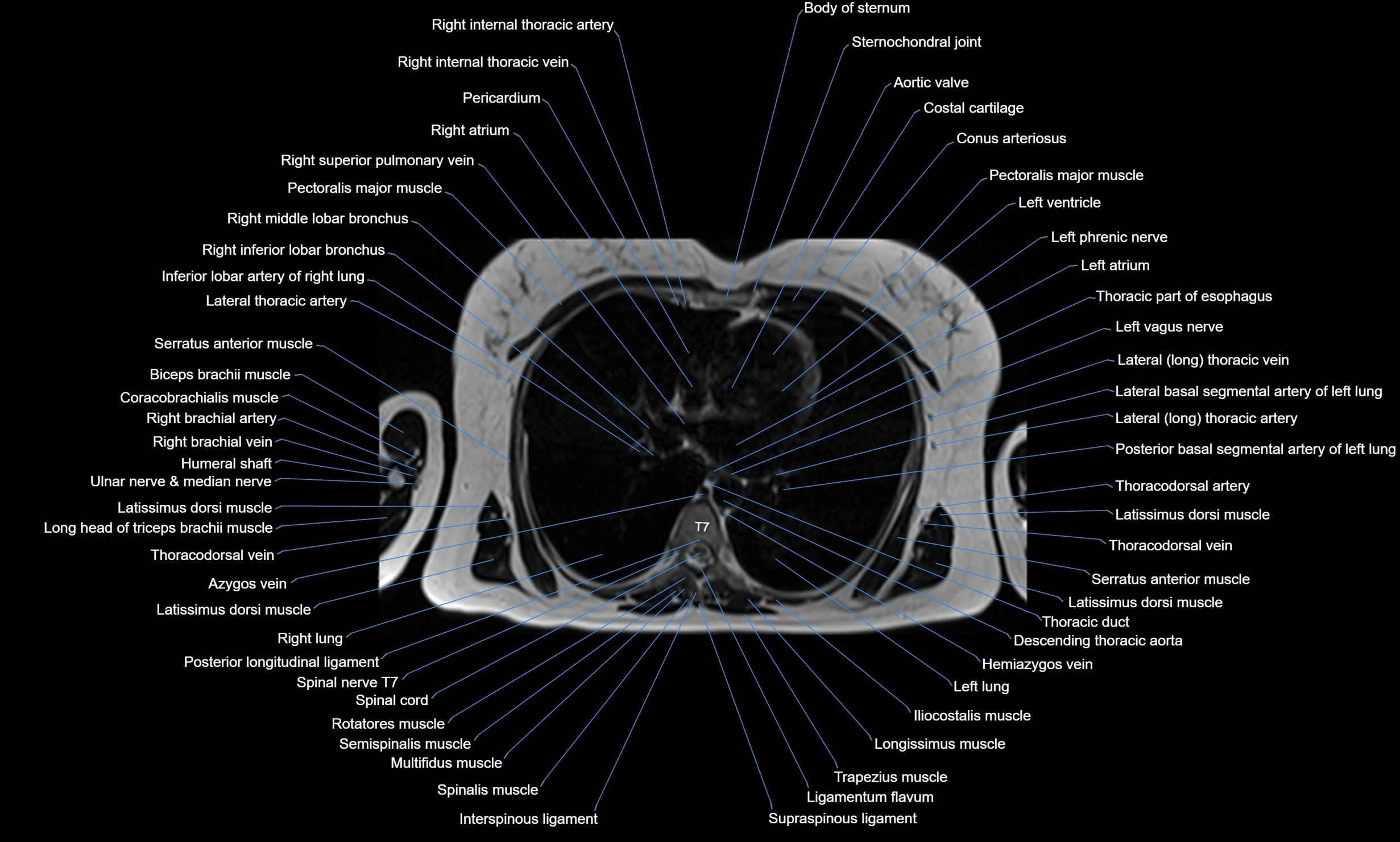 MRI Chest Anatomy – Axial, Coronal & Sagittal Planes with Labeled Images