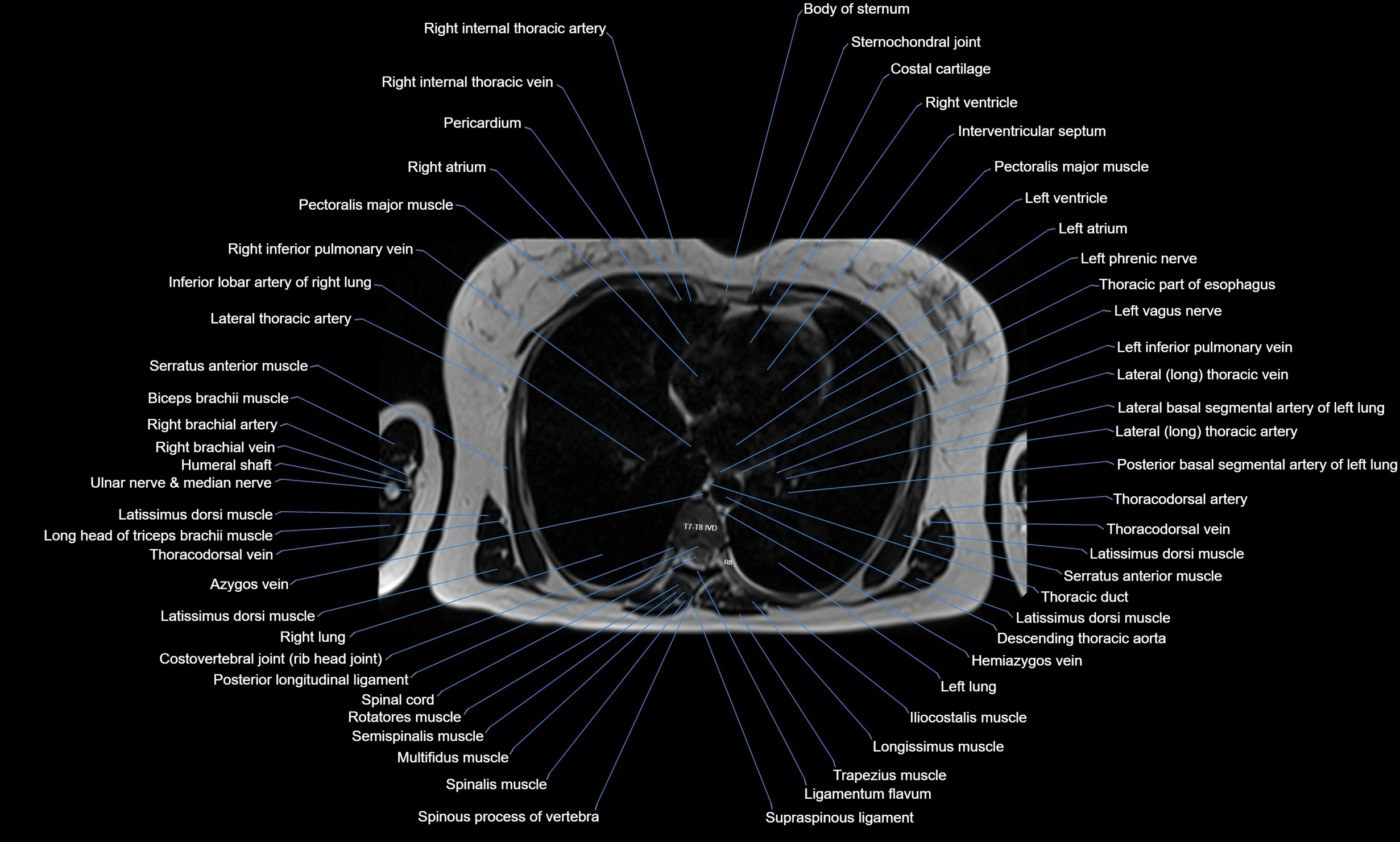 MRI Chest Anatomy – Axial, Coronal & Sagittal Planes with Labeled Images