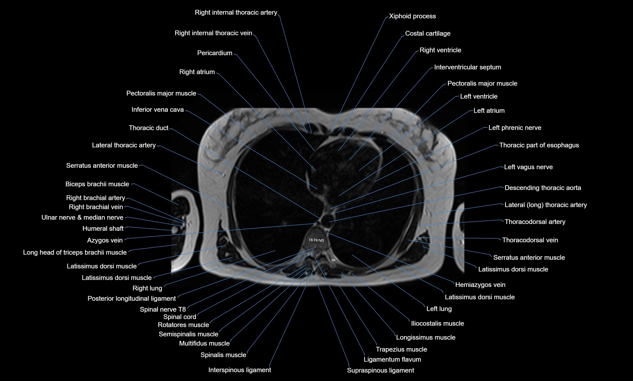 MRI Chest Anatomy – Axial, Coronal & Sagittal Planes with Labeled Images