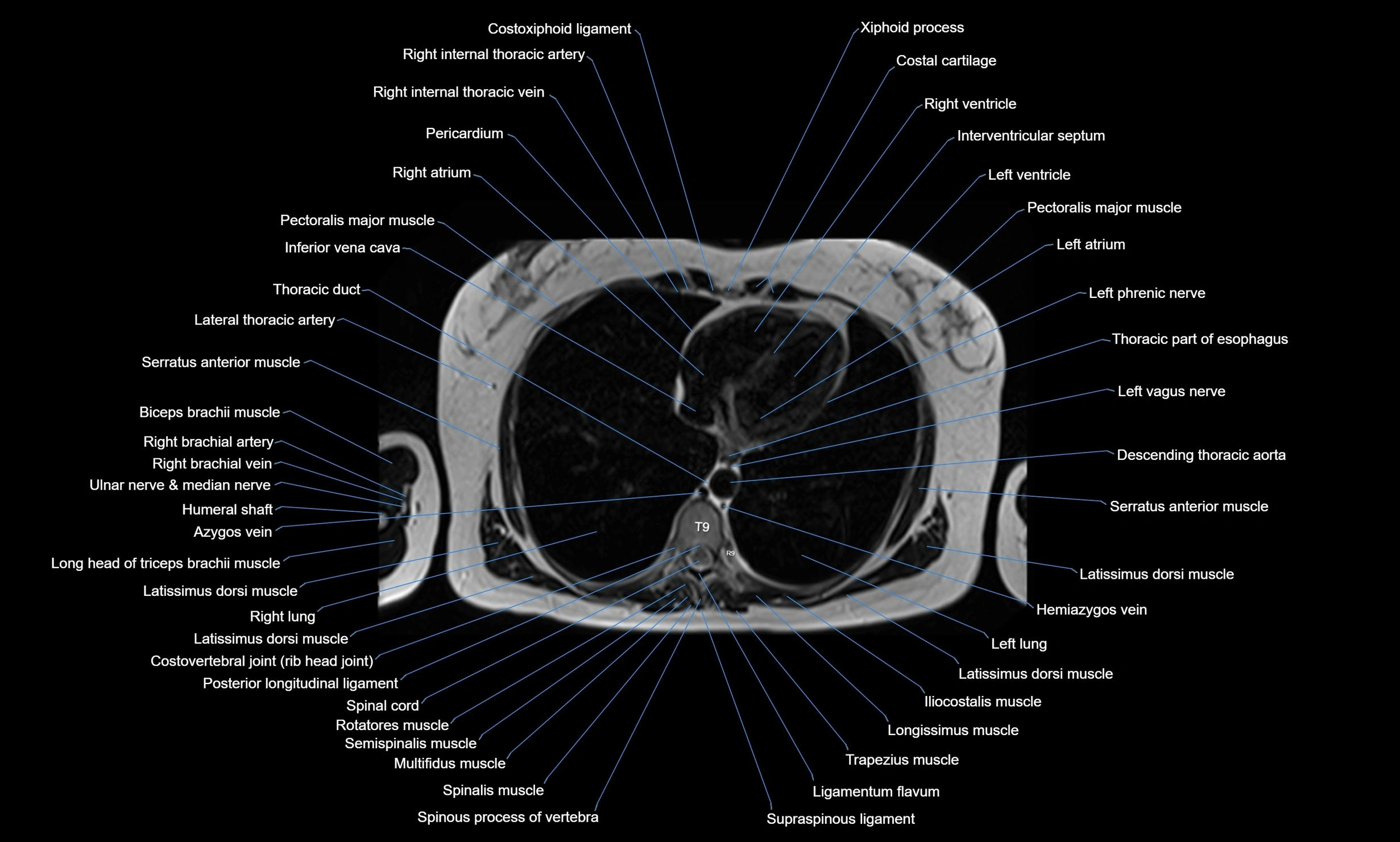 MRI Chest Anatomy – Axial, Coronal & Sagittal Planes with Labeled Images