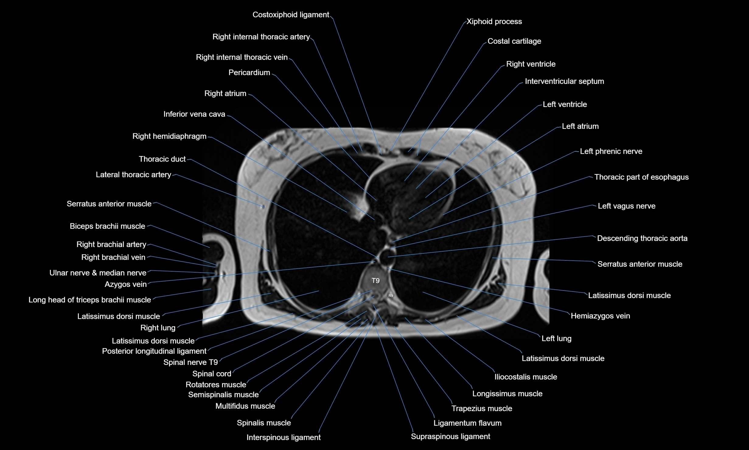 MRI Chest Anatomy – Axial, Coronal & Sagittal Planes with Labeled Images