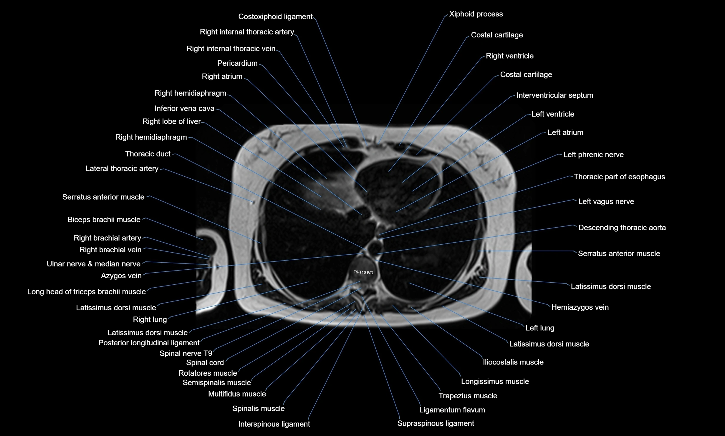 MRI Chest Anatomy – Axial, Coronal & Sagittal Planes with Labeled Images