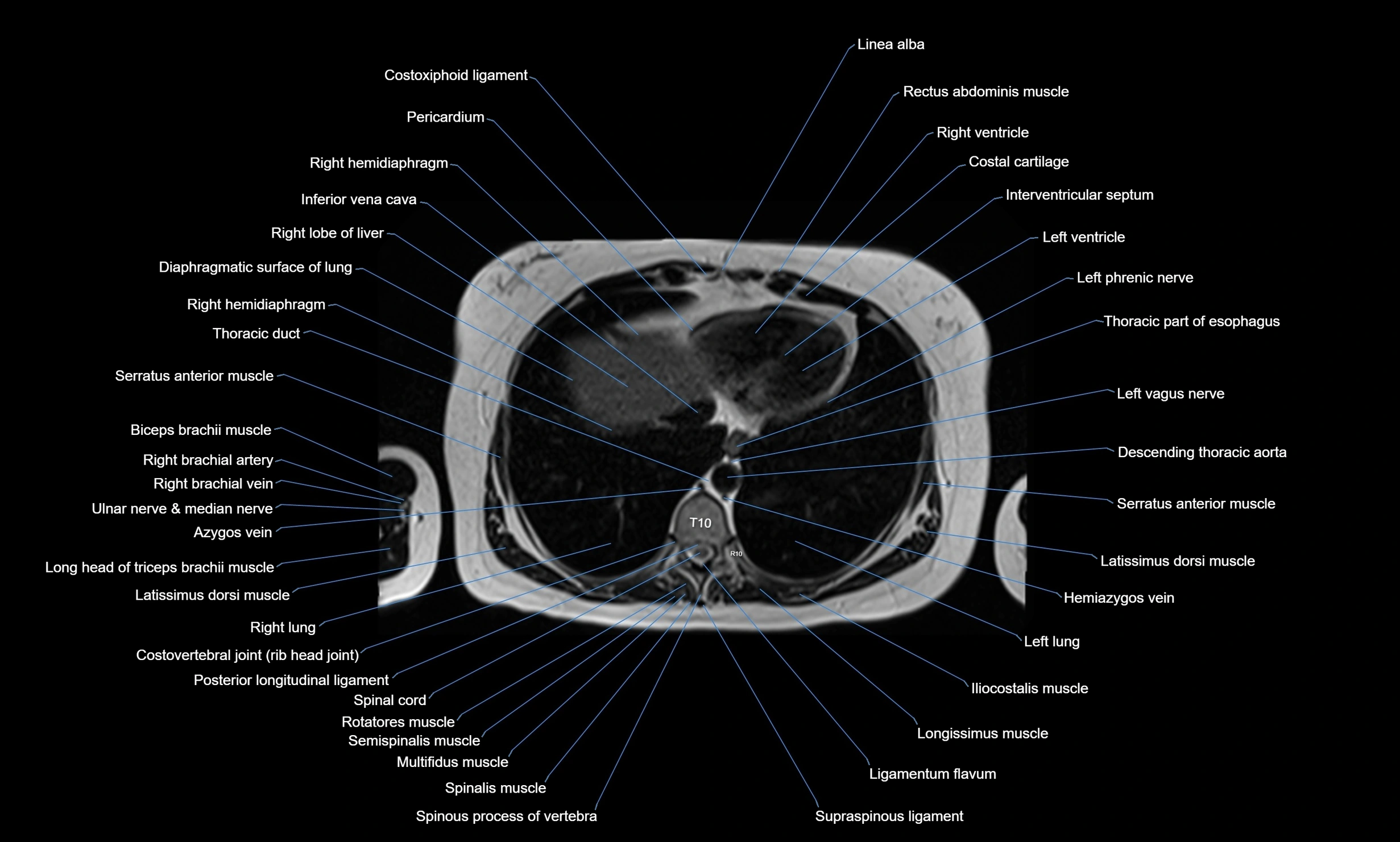 MRI Chest Anatomy – Axial, Coronal & Sagittal Planes with Labeled Images