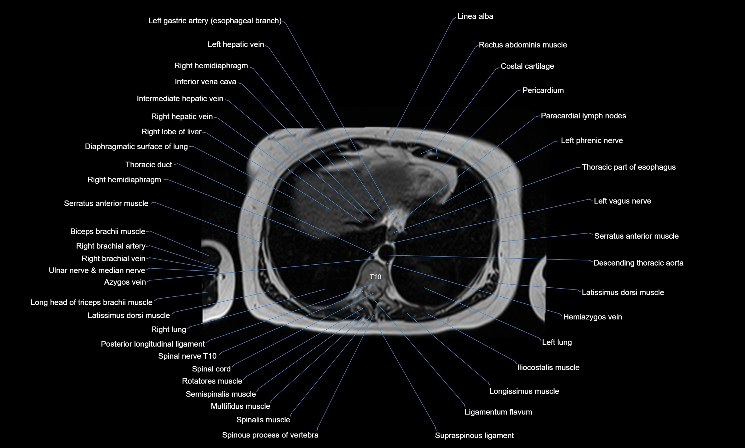 MRI Chest Anatomy – Axial, Coronal & Sagittal Planes with Labeled Images