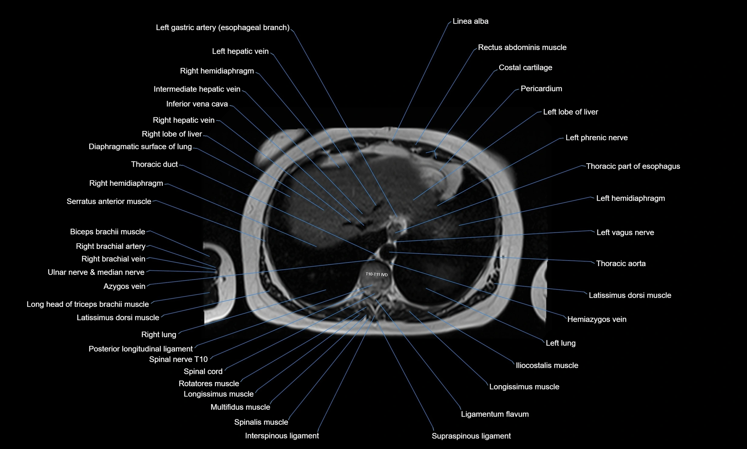 MRI Chest Anatomy – Axial, Coronal & Sagittal Planes with Labeled Images
