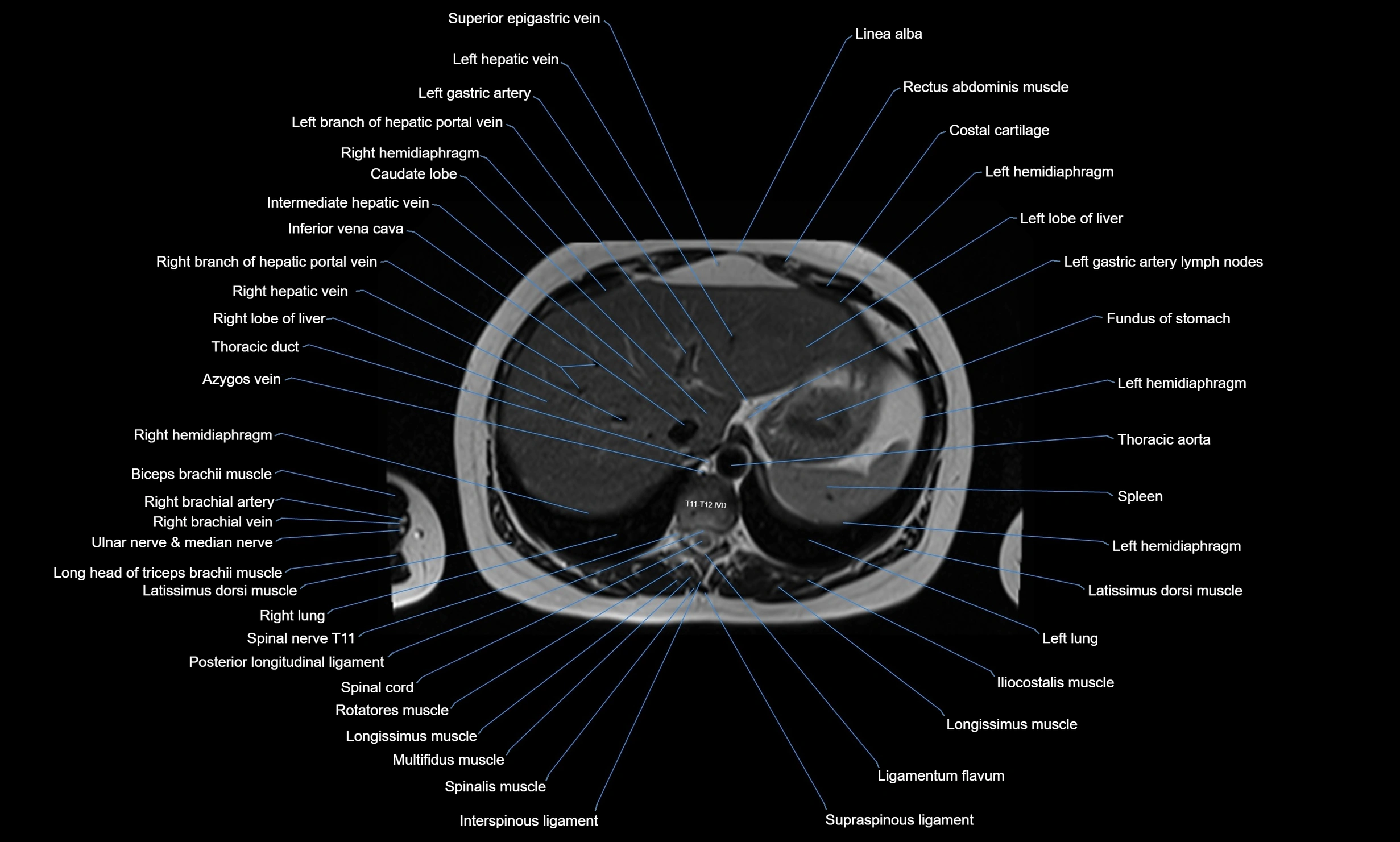 MRI Chest Anatomy – Axial, Coronal & Sagittal Planes with Labeled Images