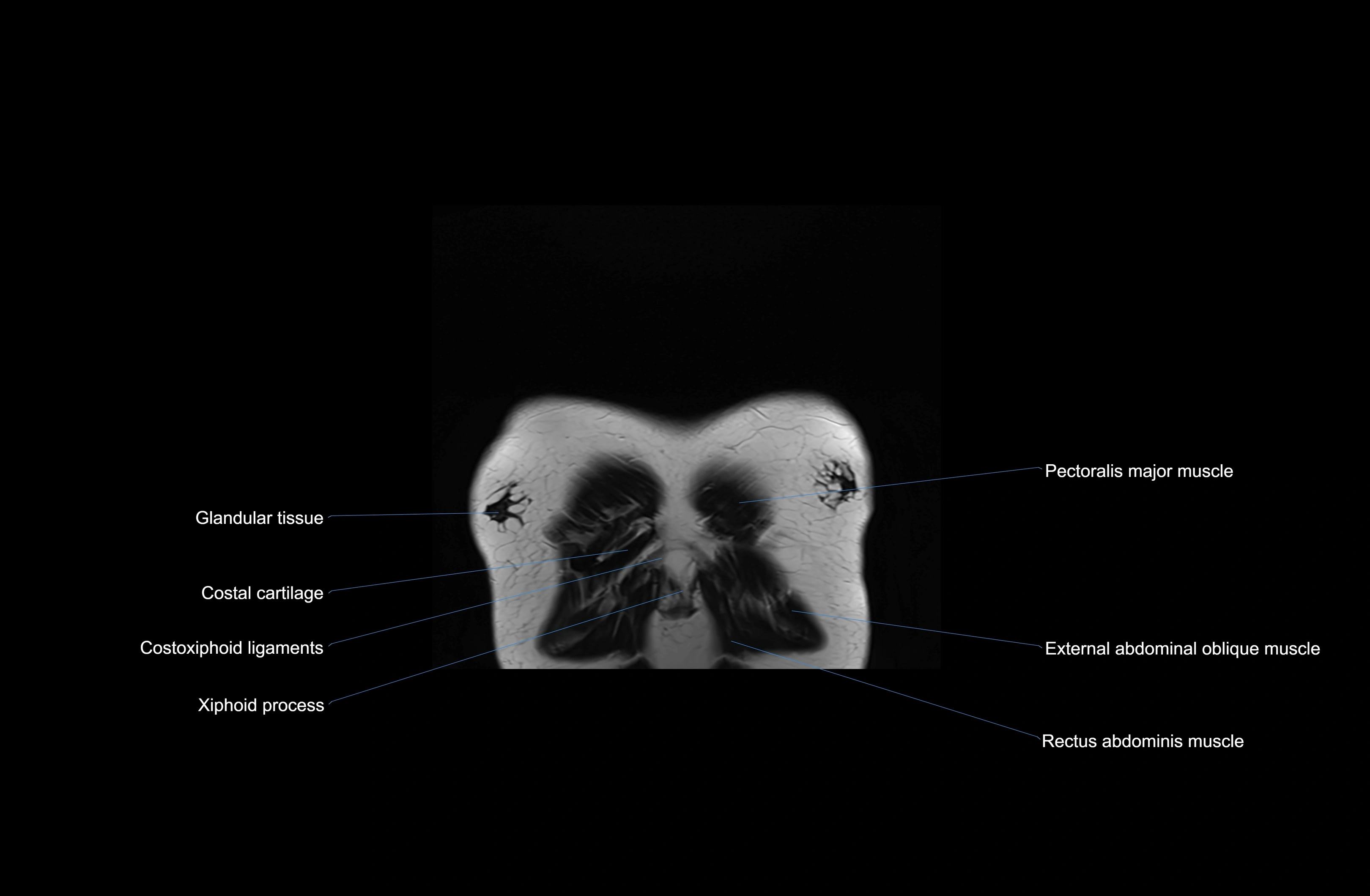 MRI Chest Anatomy – Axial, Coronal & Sagittal Planes with Labeled Images