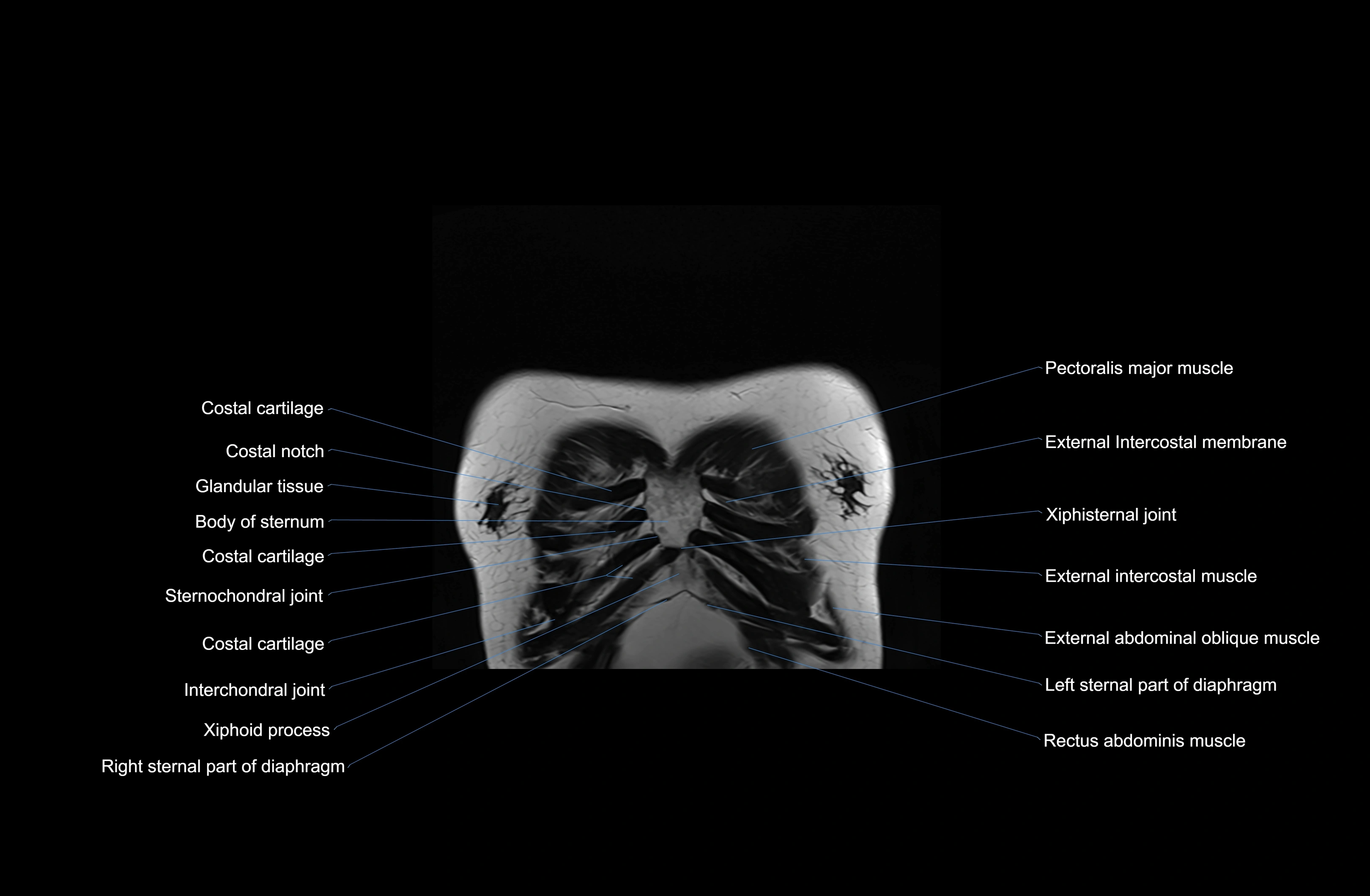 MRI Chest Anatomy – Axial, Coronal & Sagittal Planes with Labeled Images