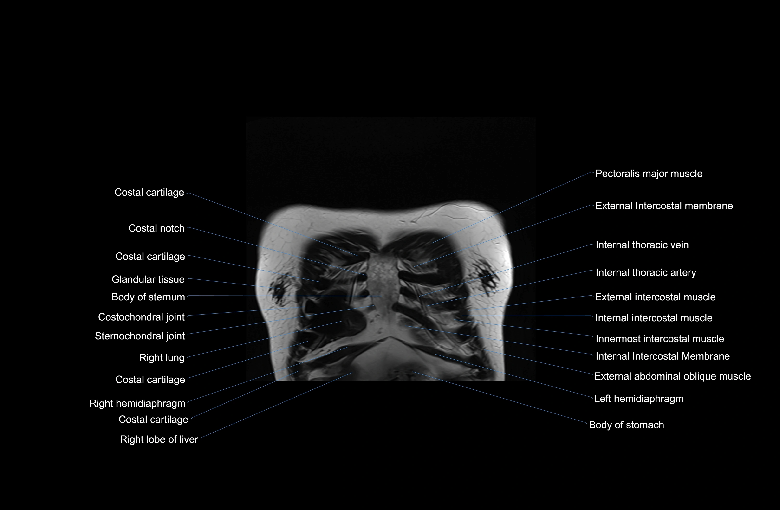 MRI Chest Anatomy – Axial, Coronal & Sagittal Planes with Labeled Images