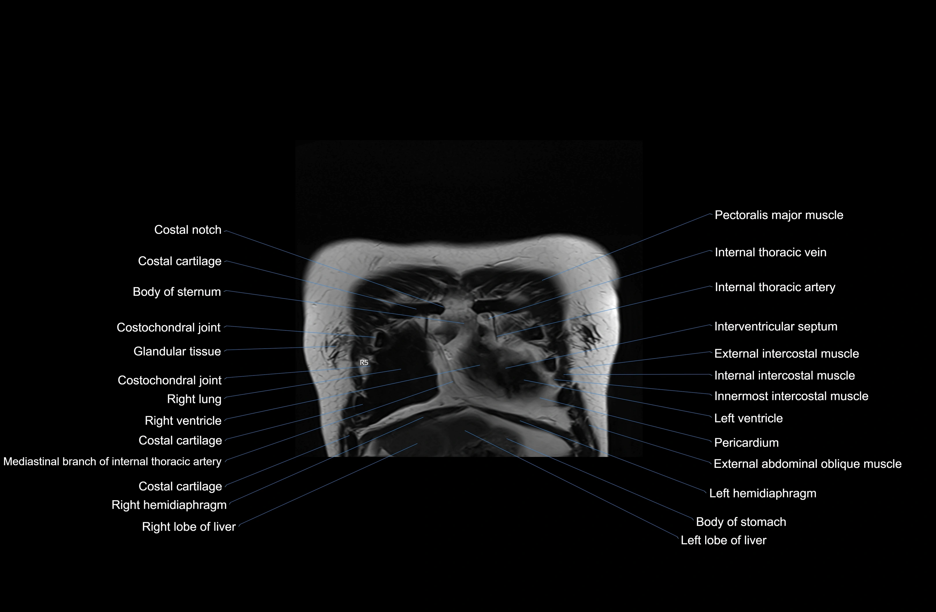 MRI Chest Anatomy – Axial, Coronal & Sagittal Planes with Labeled Images