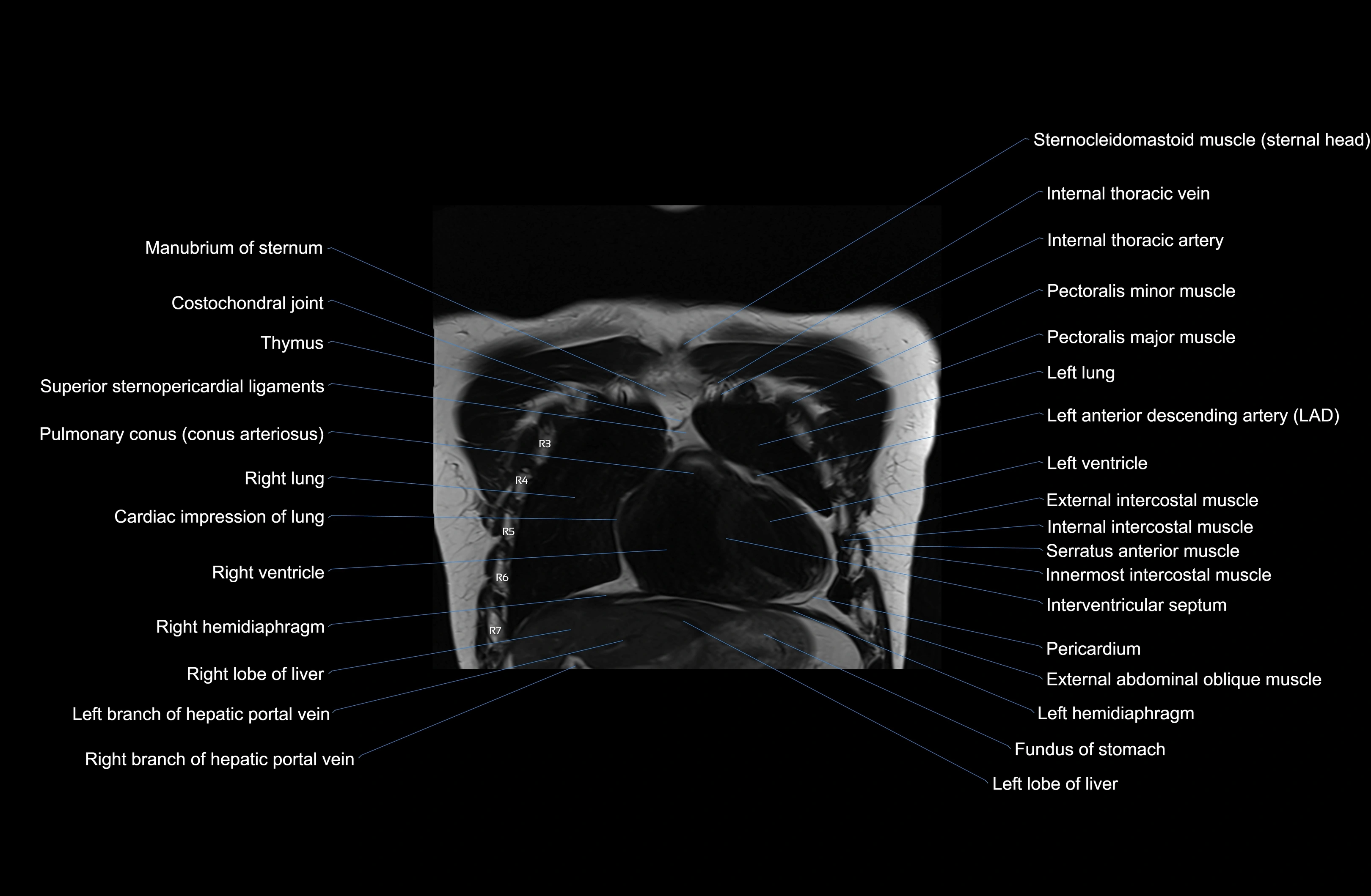 MRI Chest Anatomy – Axial, Coronal & Sagittal Planes with Labeled Images