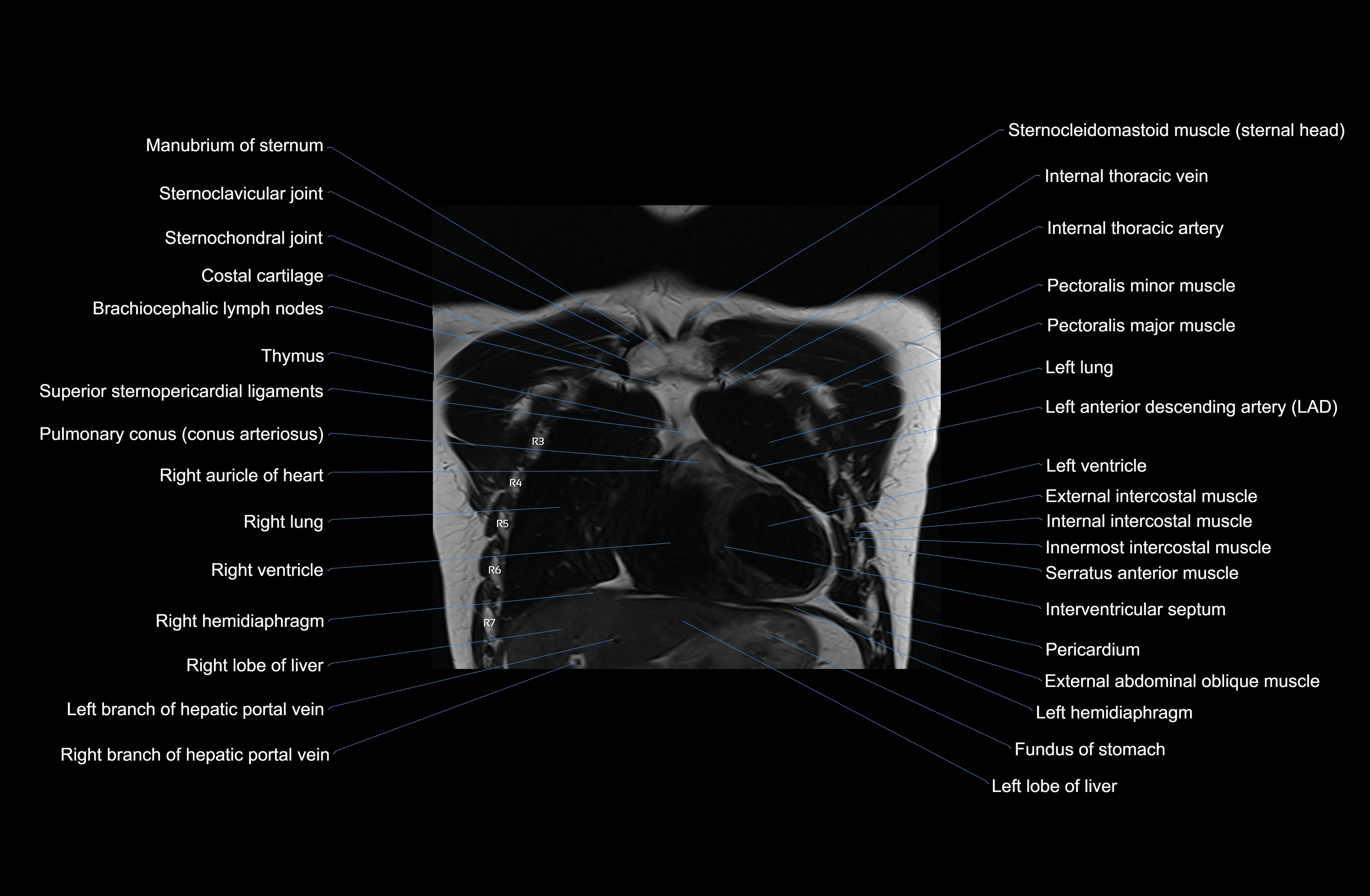 MRI Chest Anatomy – Axial, Coronal & Sagittal Planes with Labeled Images