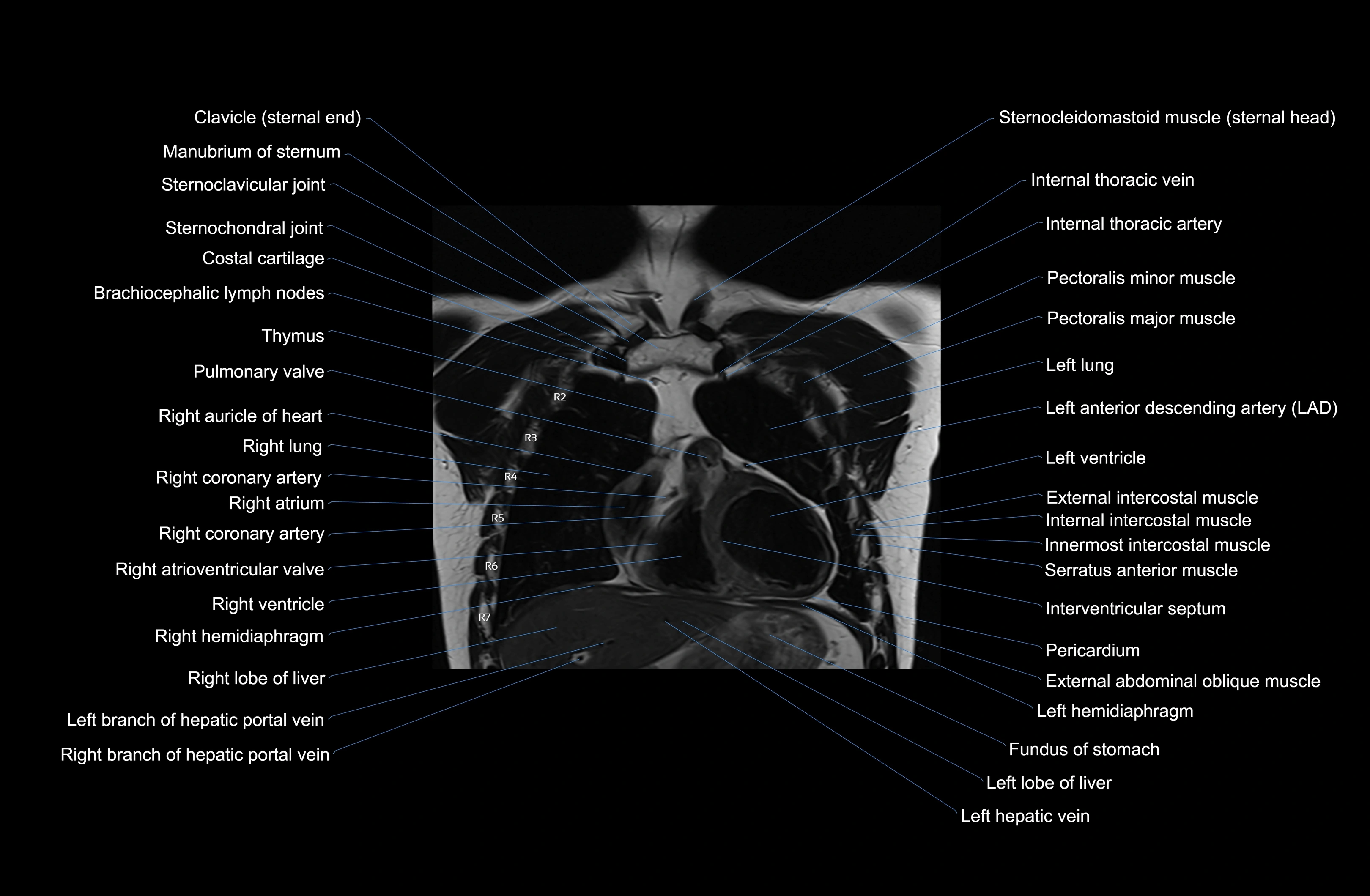 MRI Chest Anatomy – Axial, Coronal & Sagittal Planes with Labeled Images
