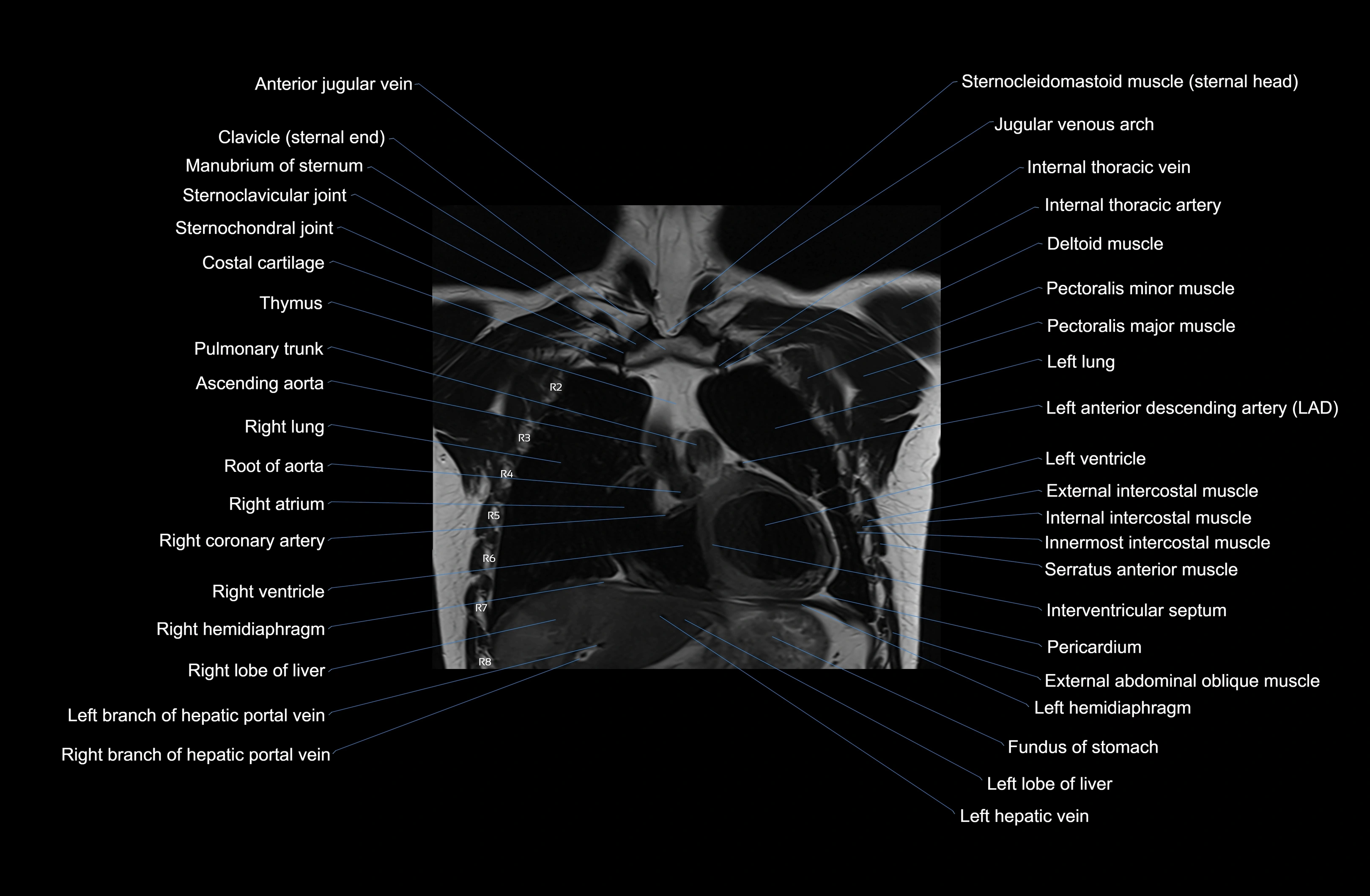 MRI Chest Anatomy – Axial, Coronal & Sagittal Planes with Labeled Images