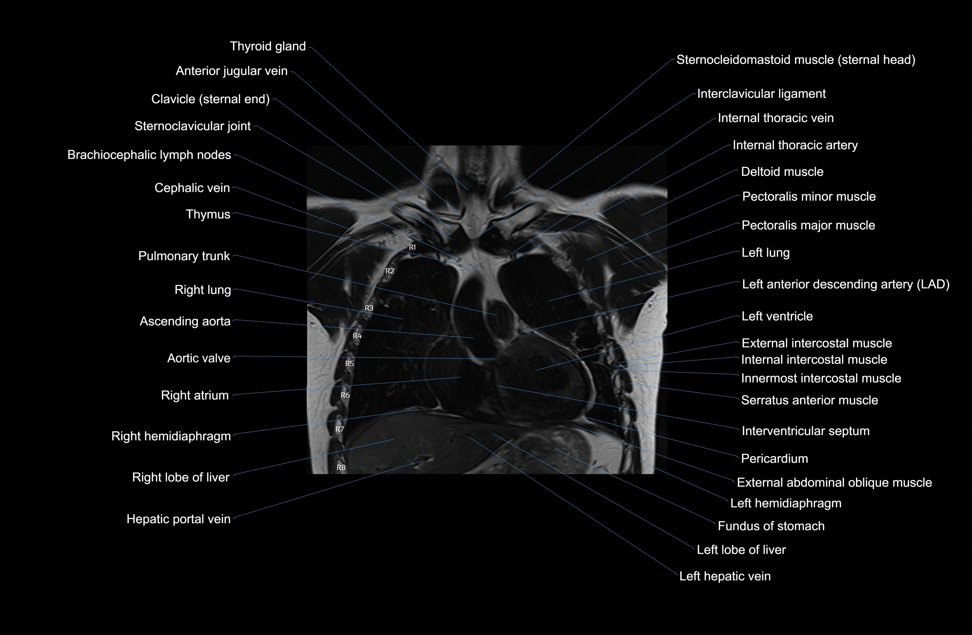 MRI Chest Anatomy – Axial, Coronal & Sagittal Planes with Labeled Images